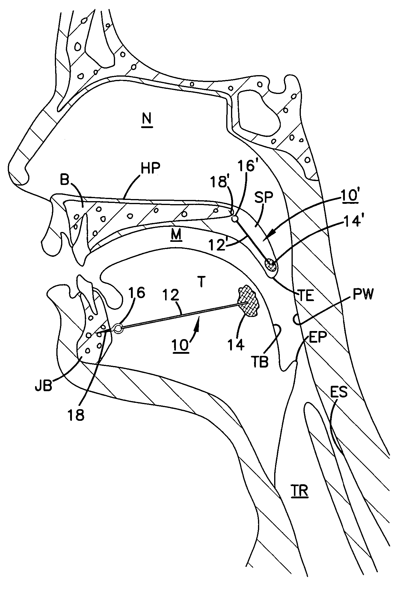 Implant for tongue