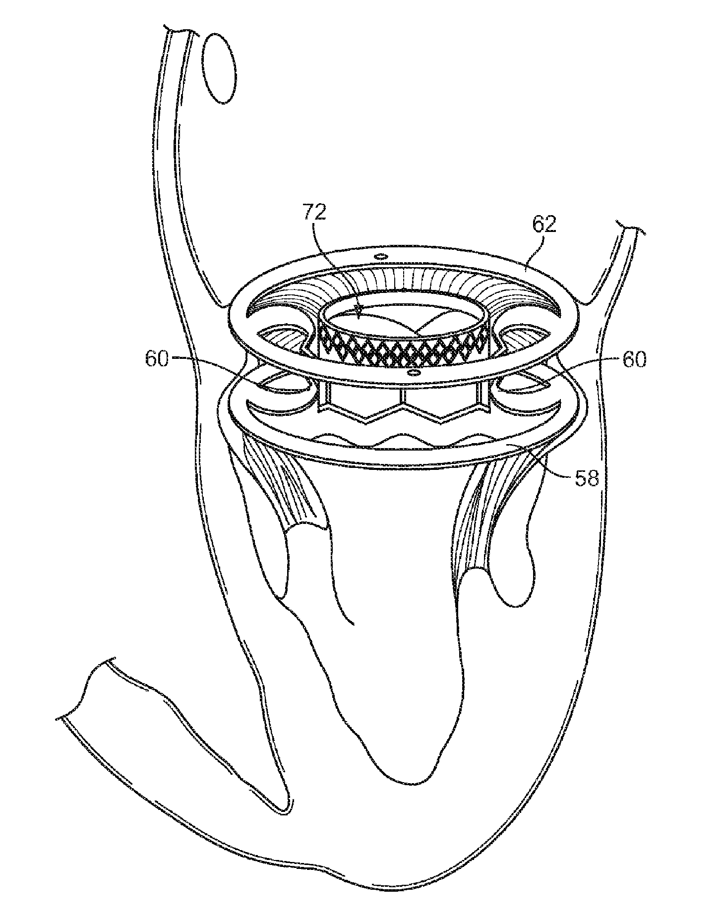 Cardiac valve support structure