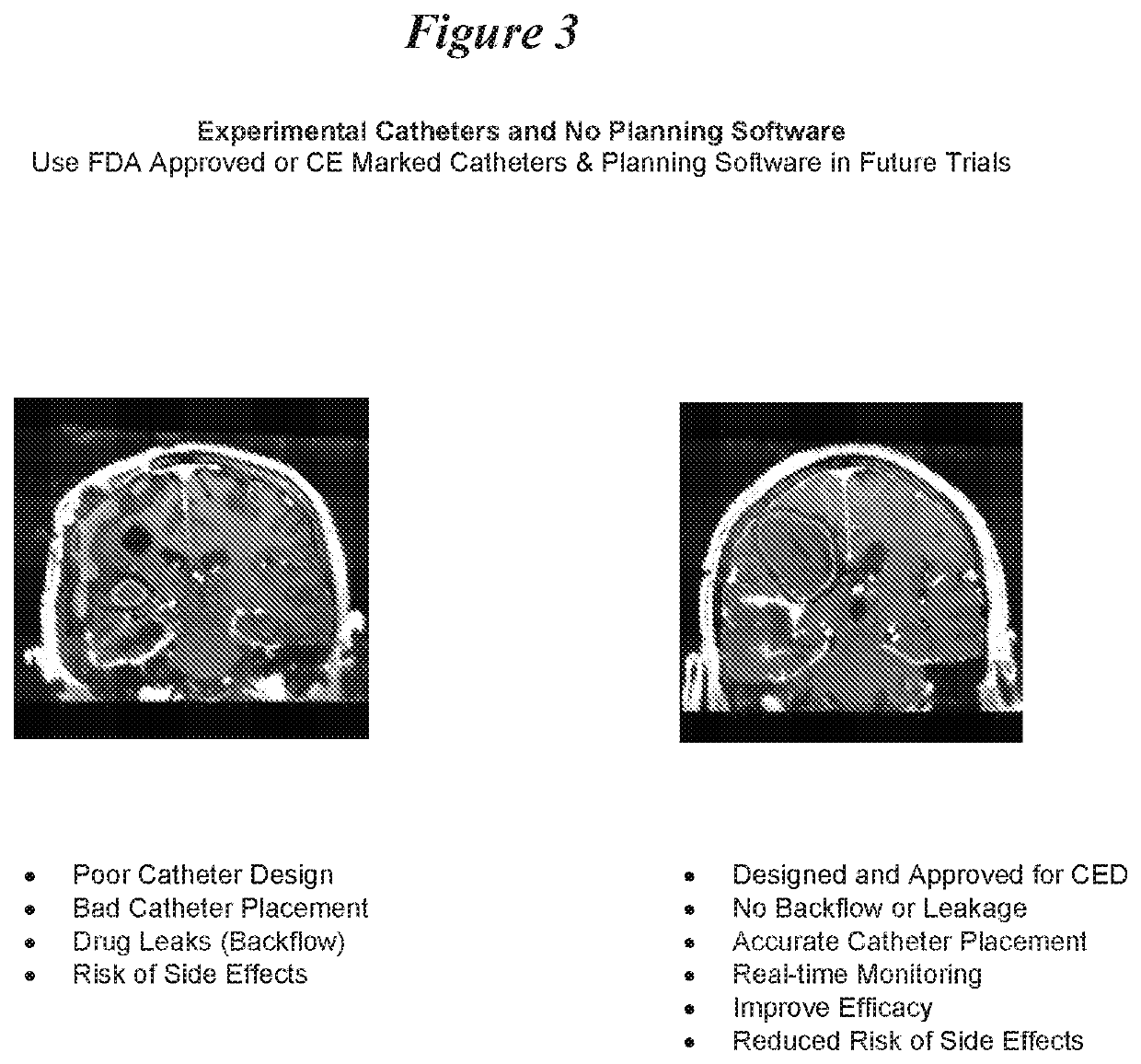 Il-4-fusion formulations for treatment of central nervous system (CNS) tumors