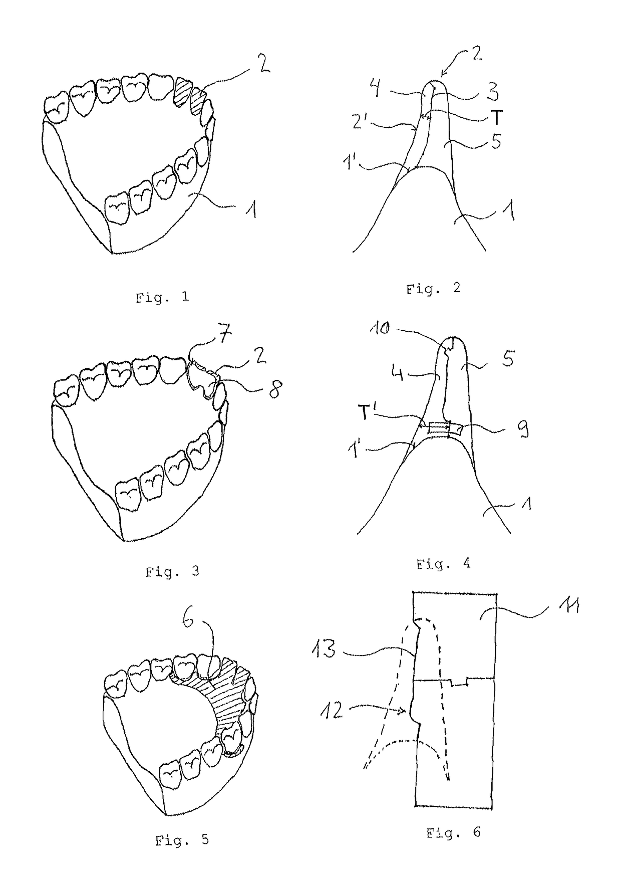 Method for generating a model of a dental replacement part