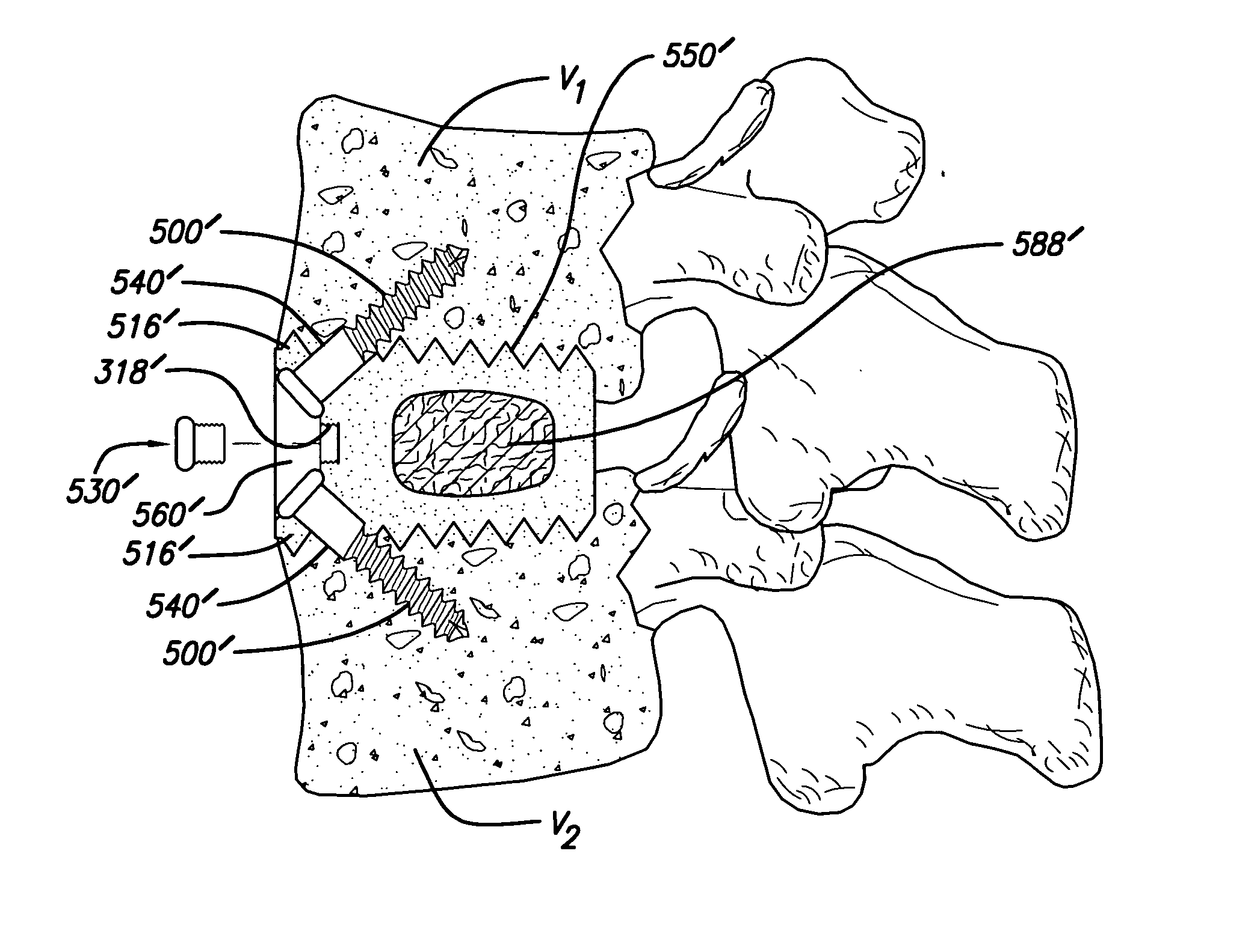 Implant having upper and lower extended members and method for use thereof