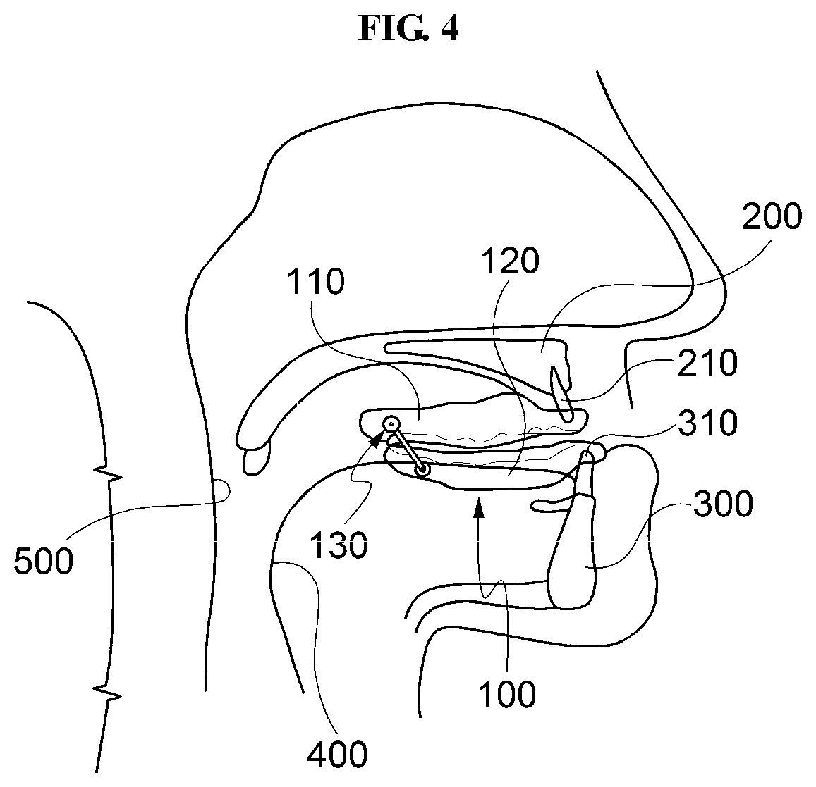 Device for moving lower jaw forward