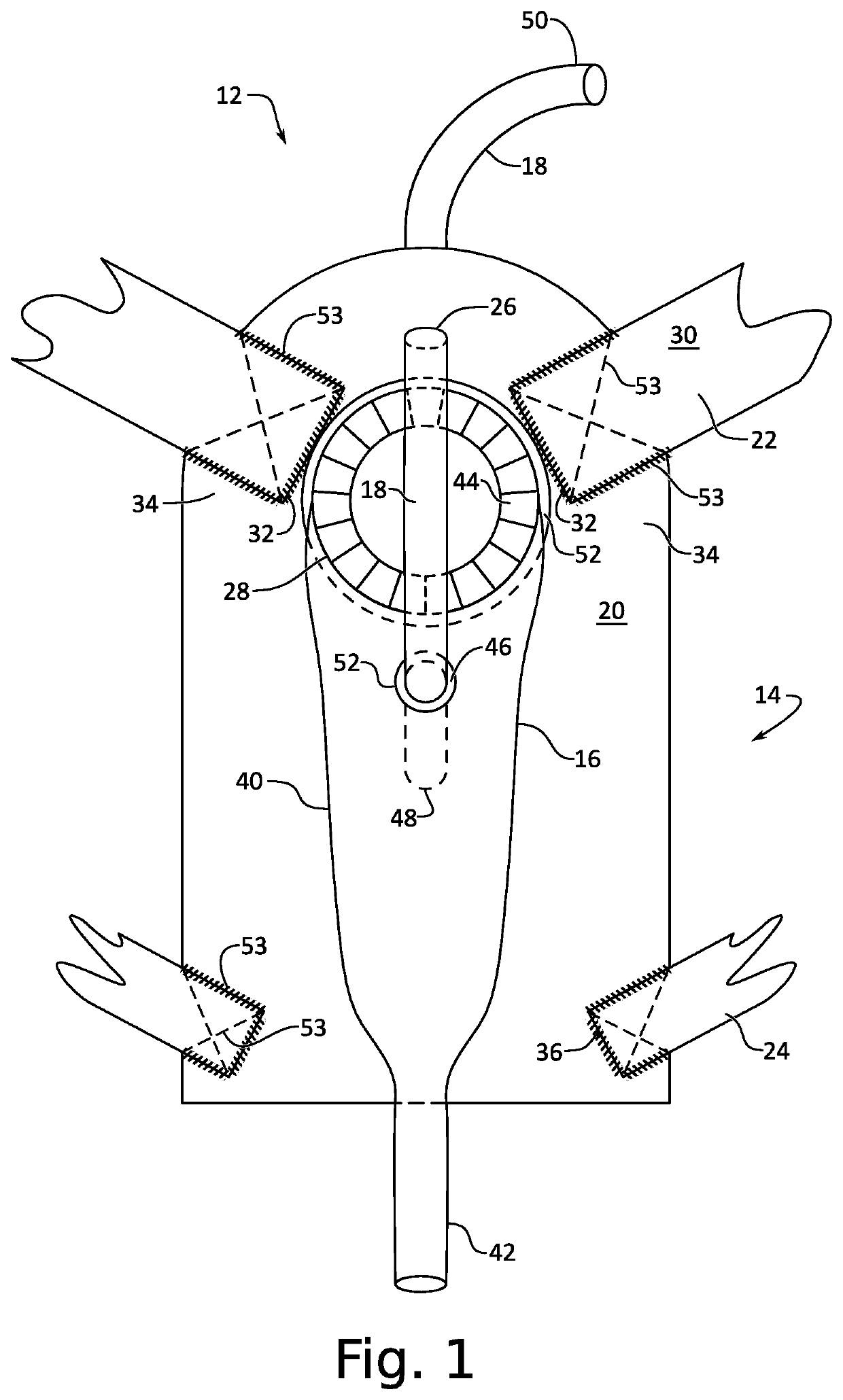 External catheter