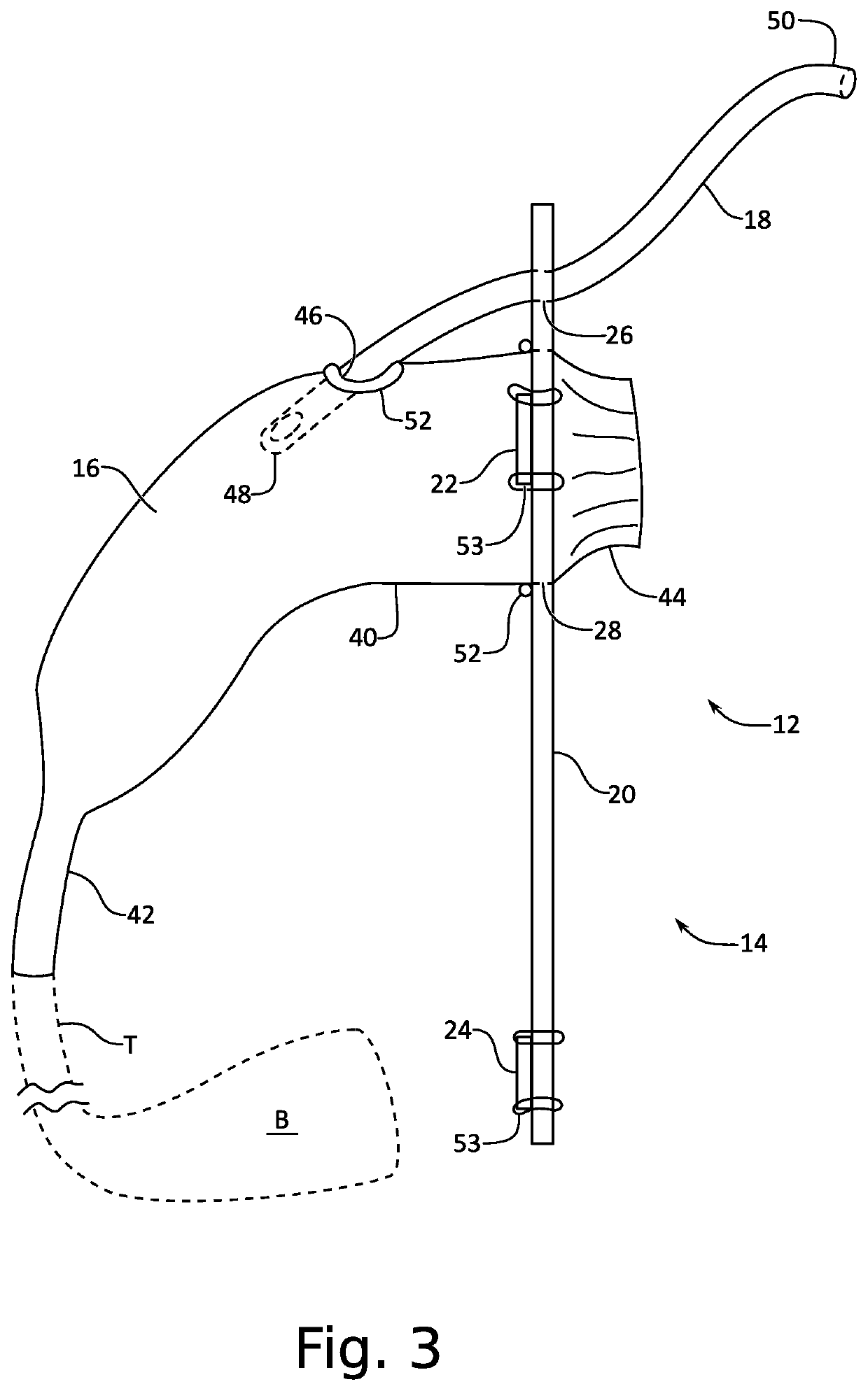 External catheter