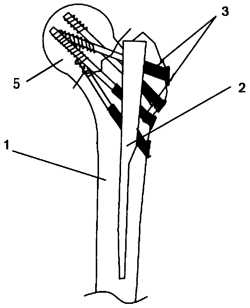 Femoral intramedullary distributed anti-rotation fixing device