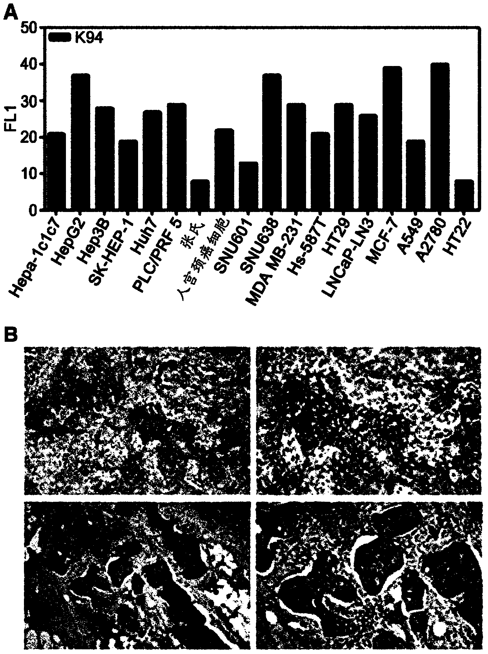 A marker comprising anti-CK8/18 complex autoantibody and its use for diagnosing cancer