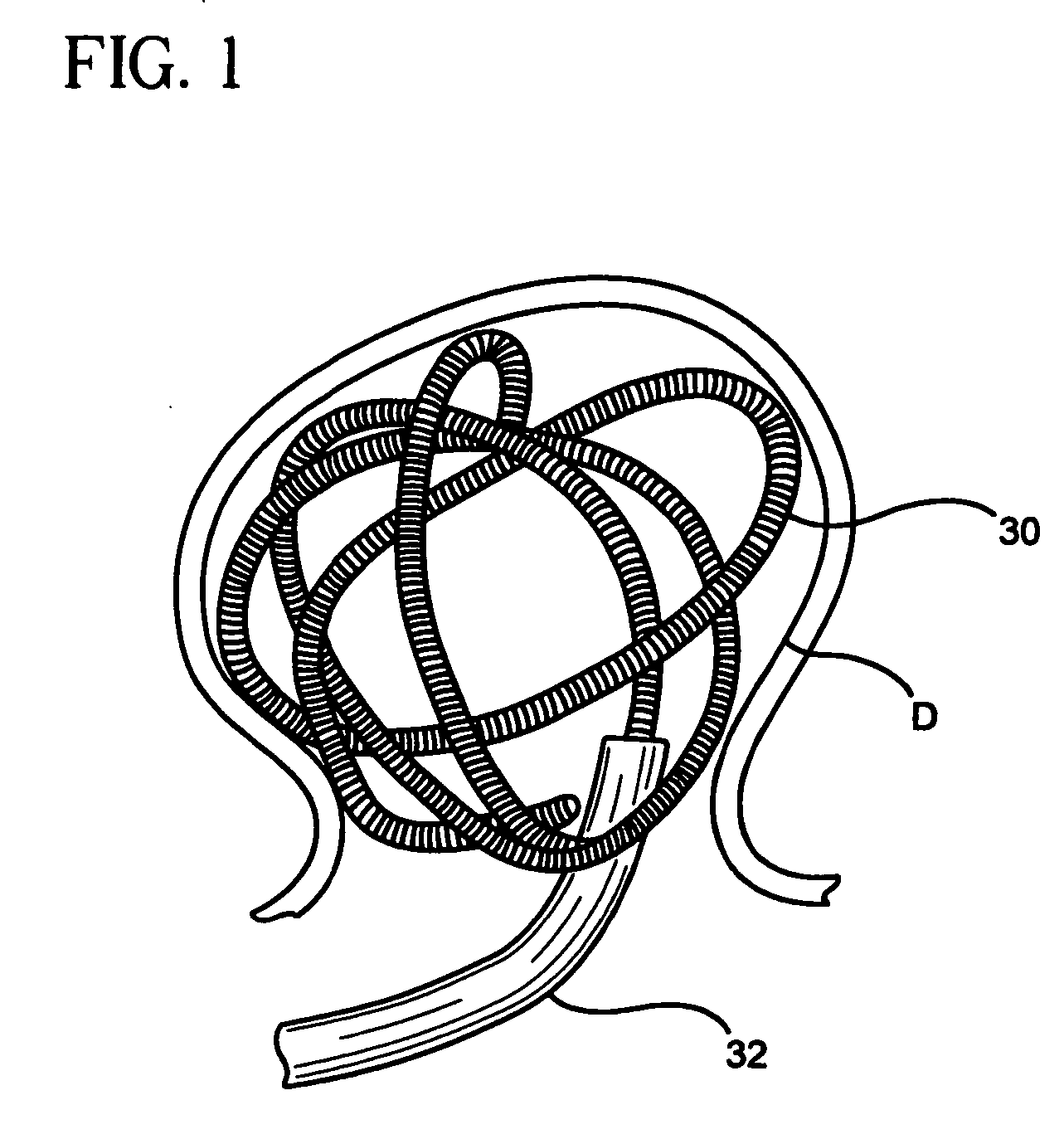 Methods of, and materials for, treating vascular defects with magnetically controllable hydrogels