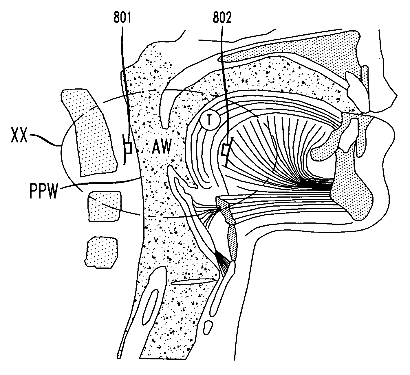 Magnetic implants and methods for treating an oropharyngeal condition