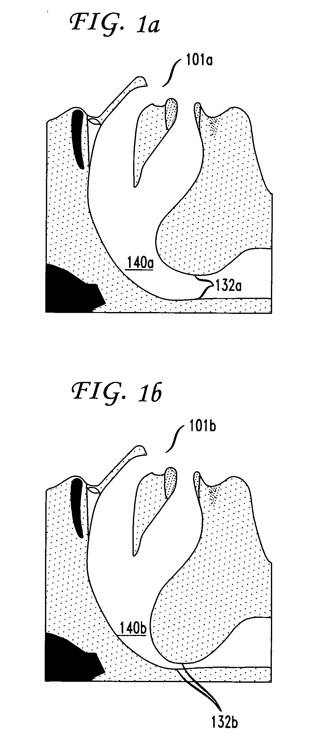 Magnetic implants and methods for treating an oropharyngeal condition