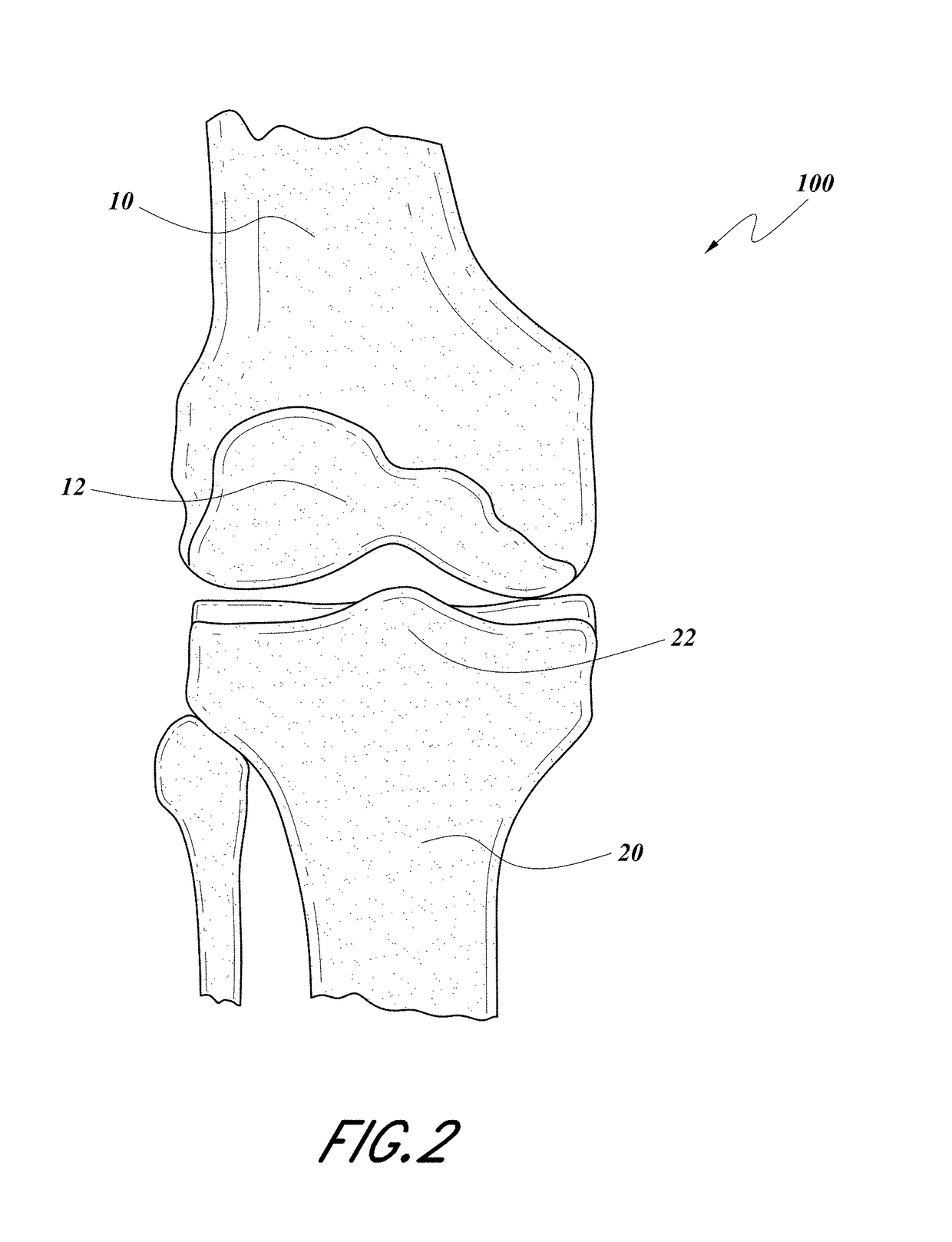 Modular total knee arthroplasty system and method