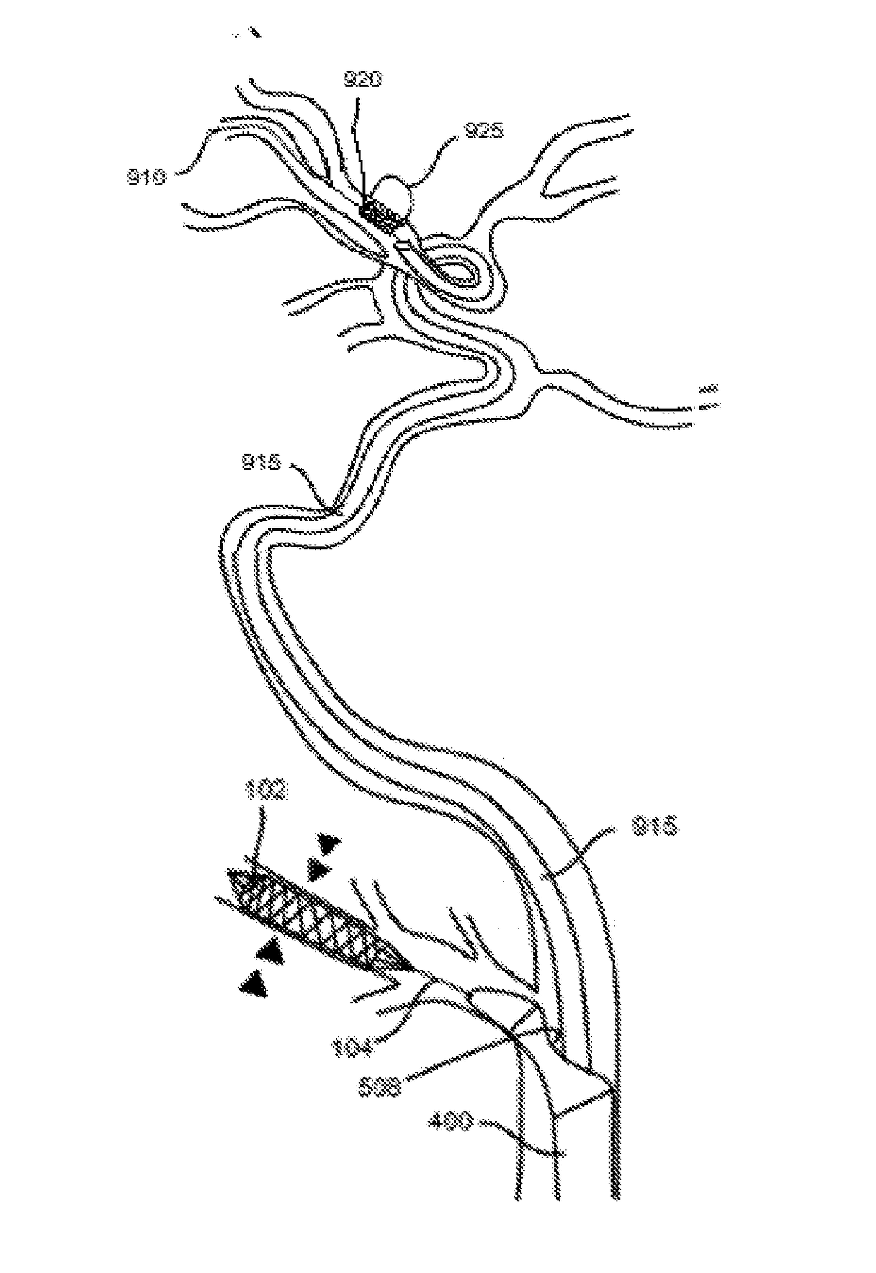 Methods of intracerebral implant delivery