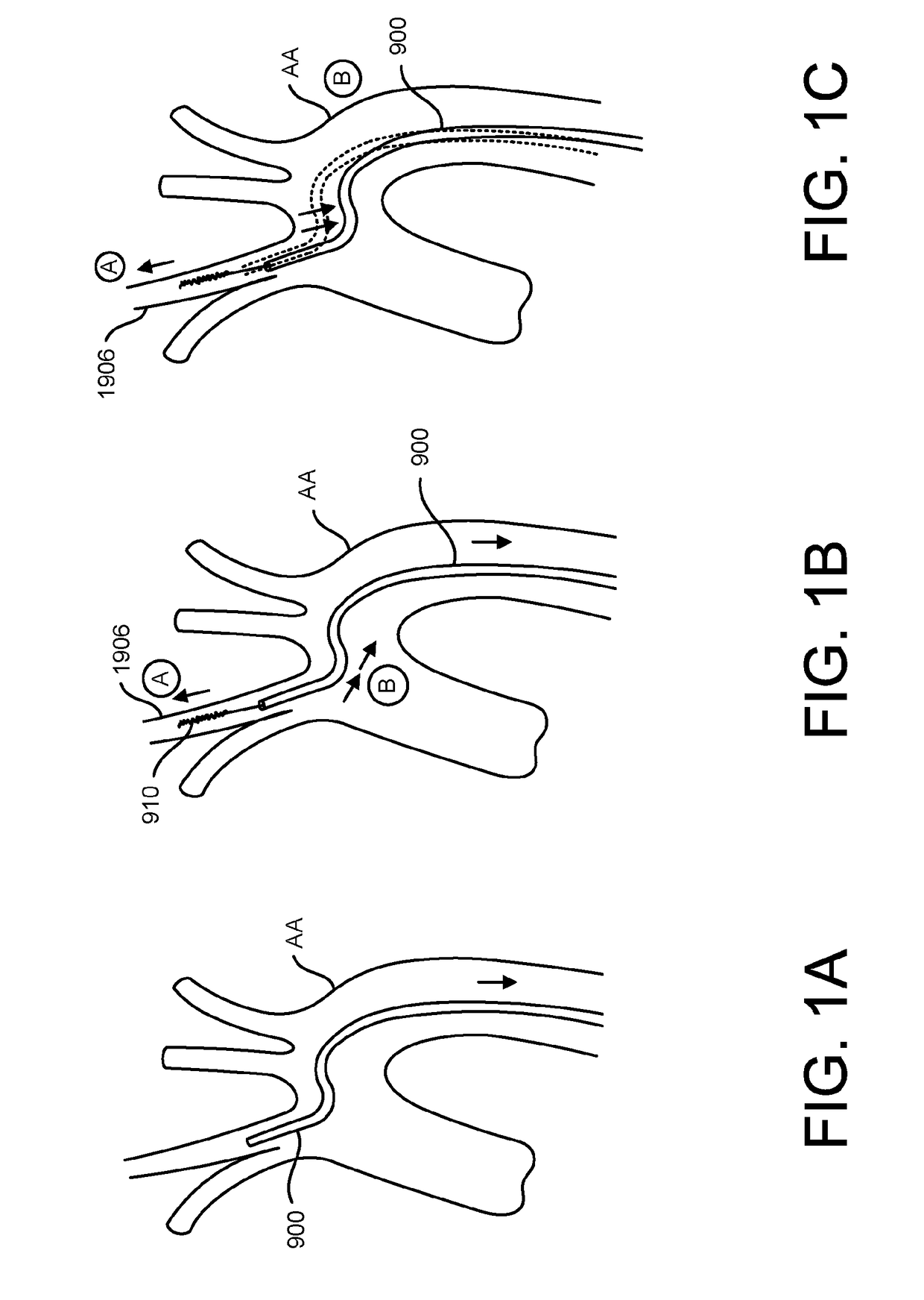 Methods of intracerebral implant delivery