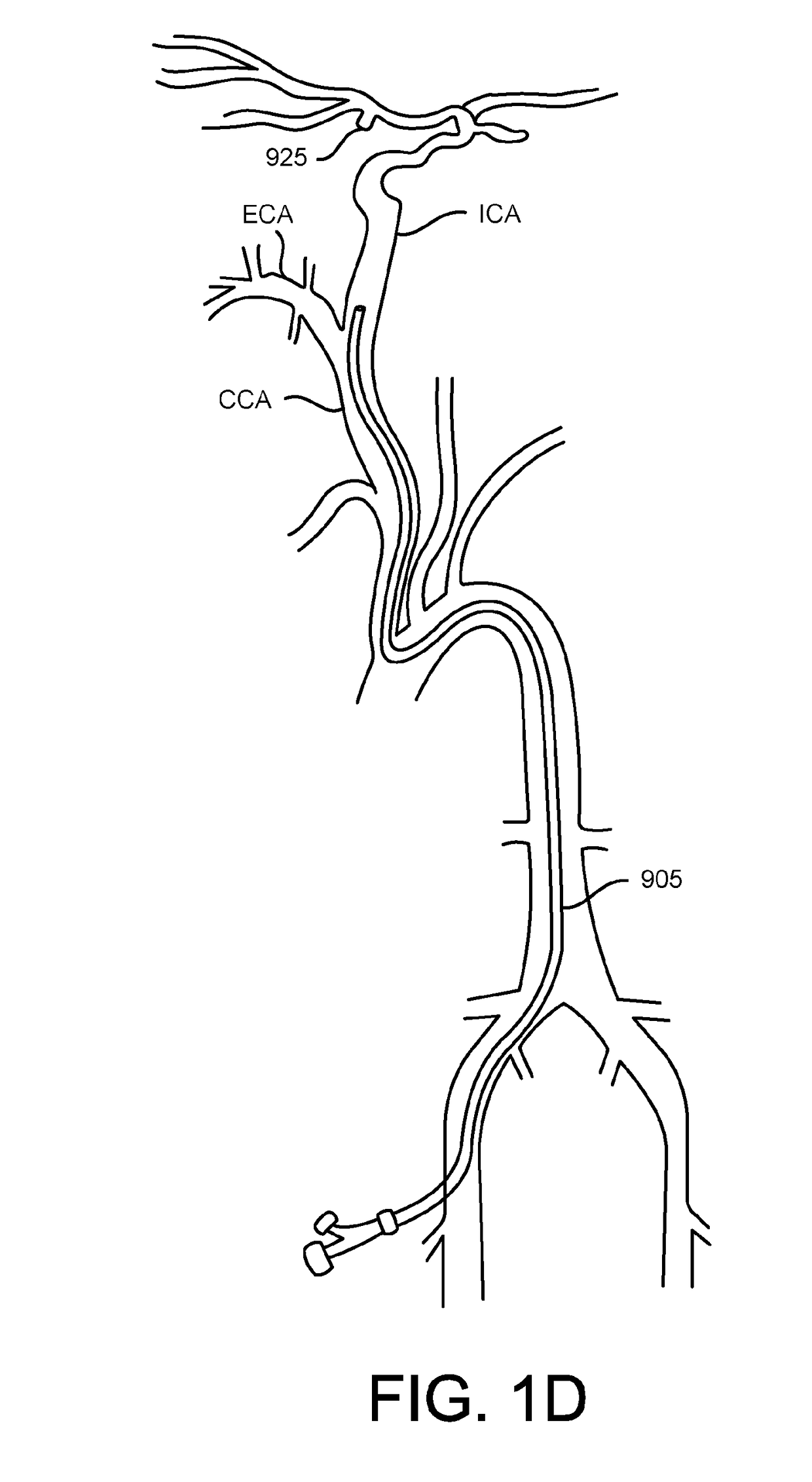 Methods of intracerebral implant delivery