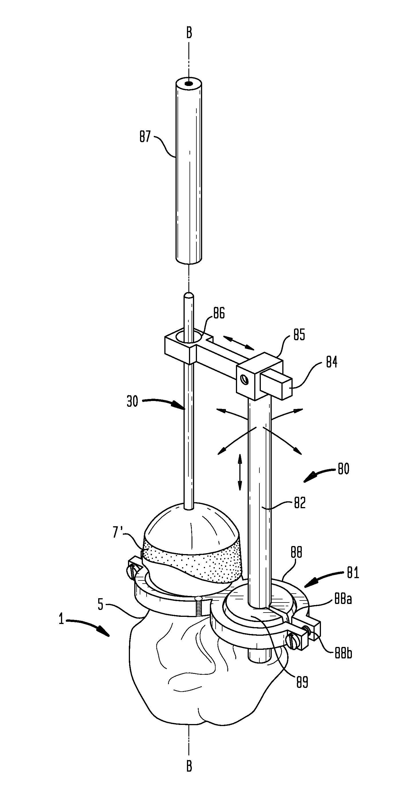 Method and apparatus for hip femoral resurfacing tooling