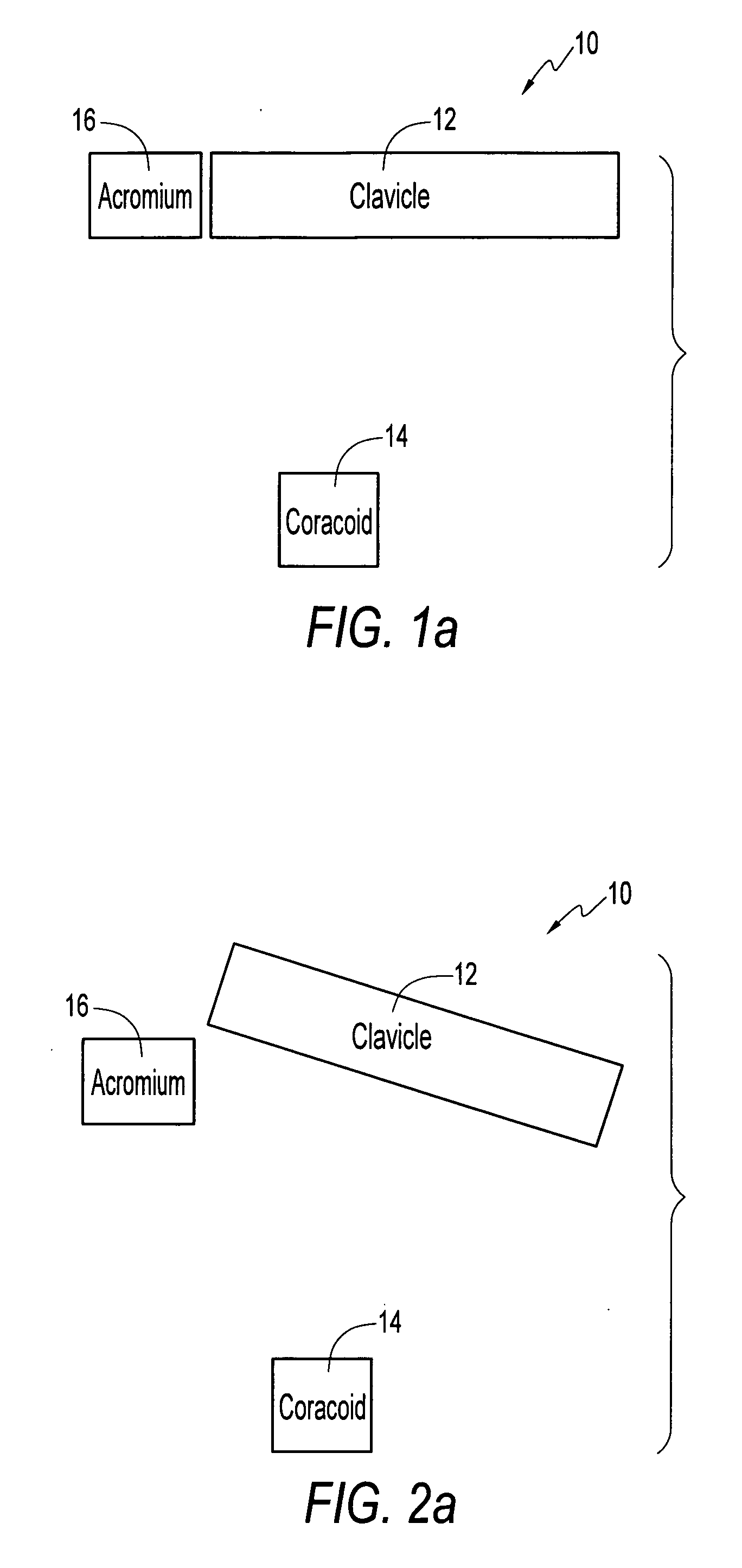 Method and apparatus for internal fixation of an acromioclavicular joint dislocation of the shoulder