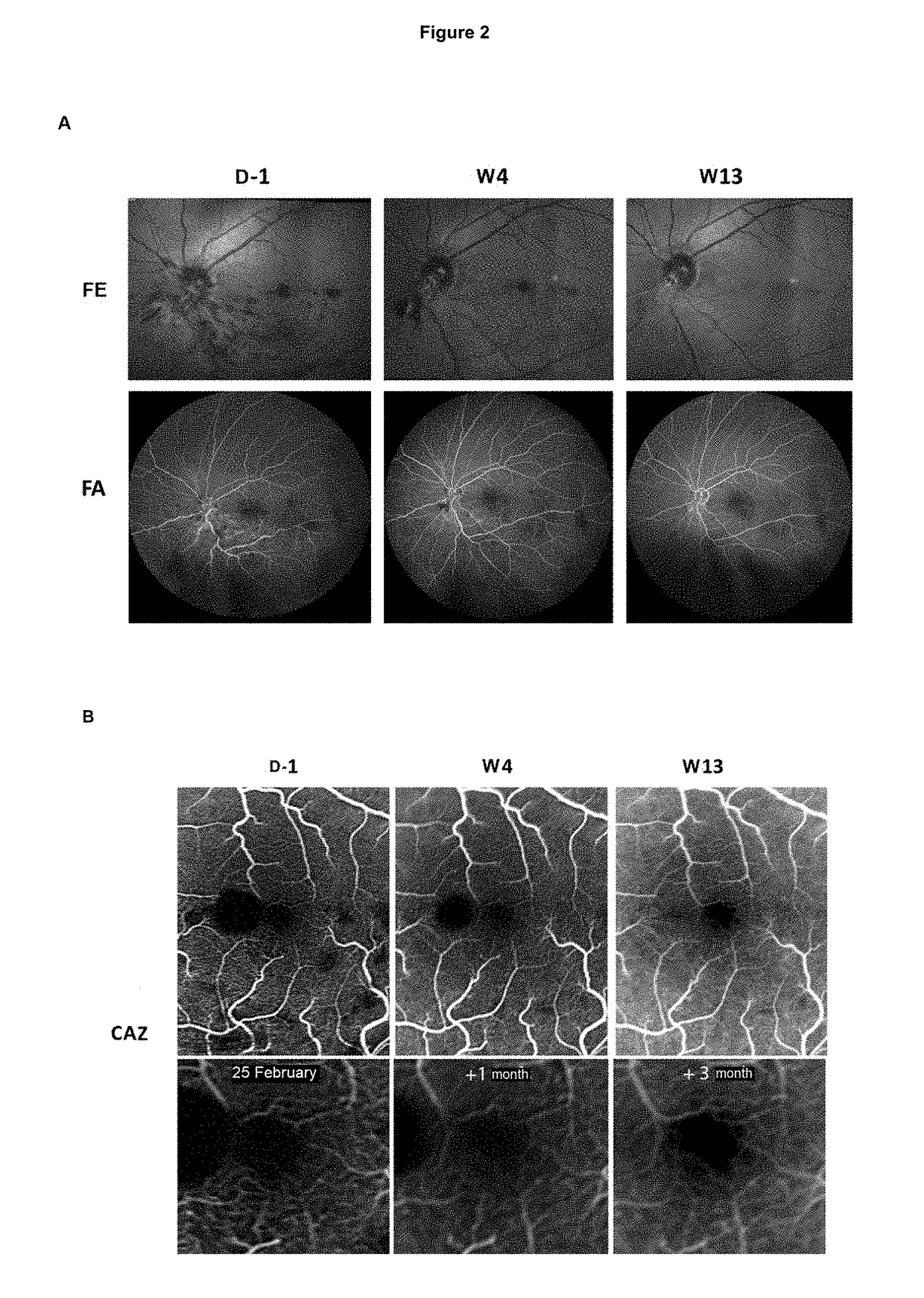 Use of hydroxycarbamide for preventing retinal nonperfusion