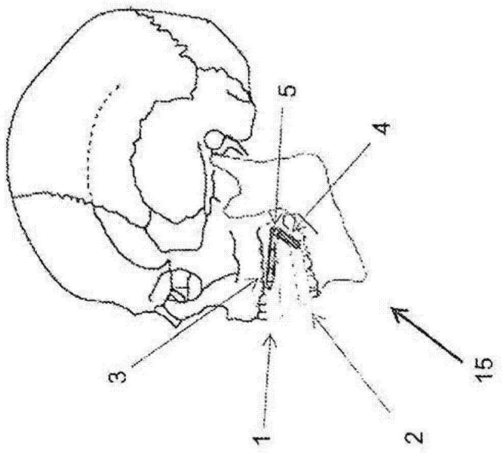 Dental apparatus for treating malocclusion