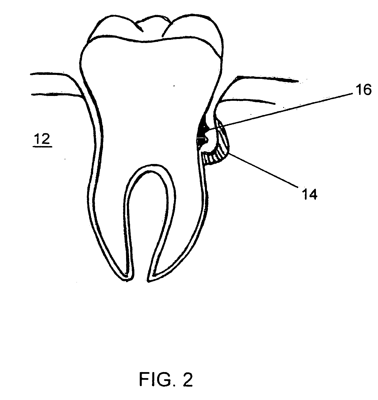 Non-invasive method for treating periodontal disease