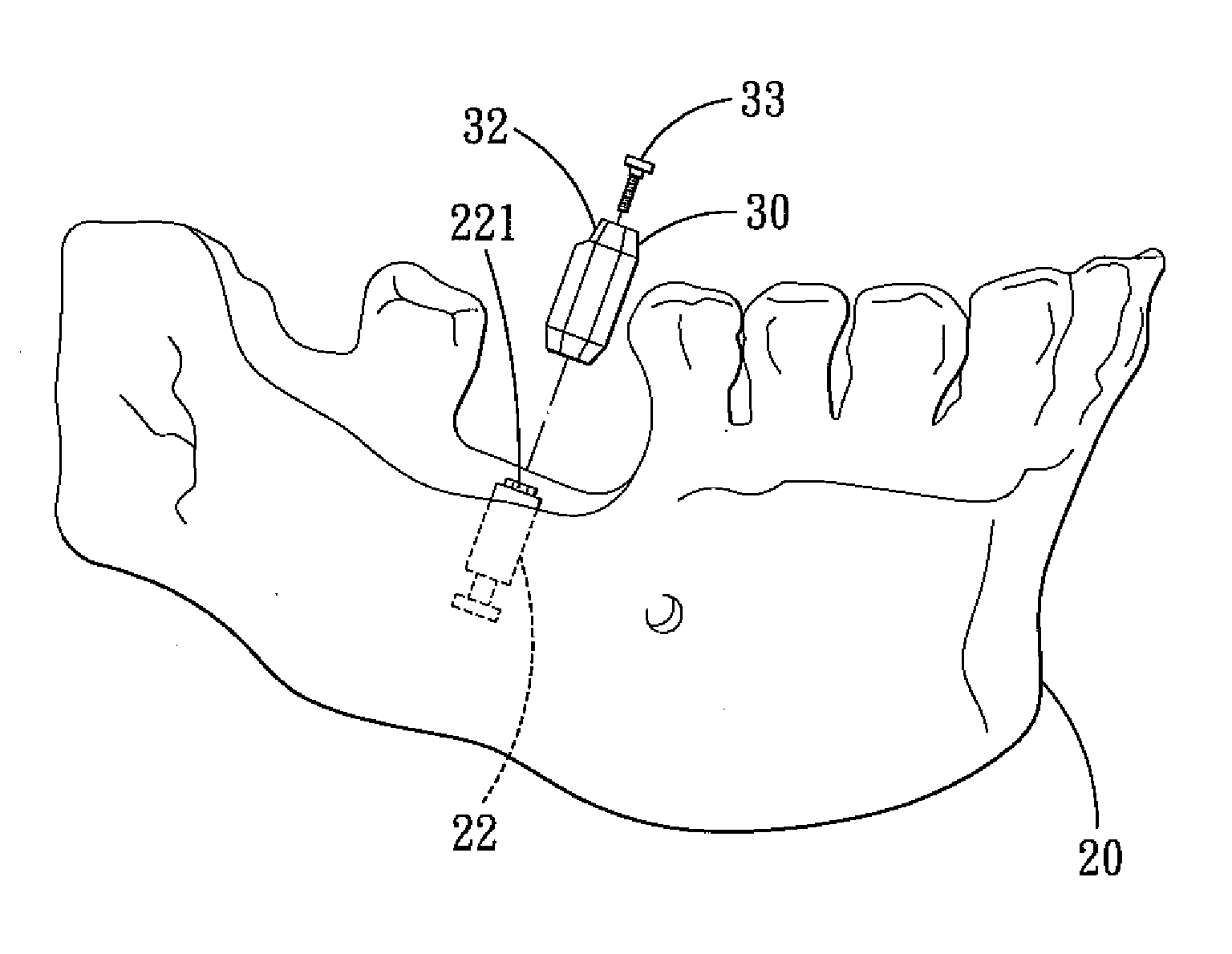 Method for Designing an Abutment