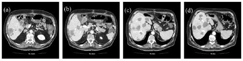 An Automatic Segmentation Method of Liver Tumor Region Images in Abdominal CT Sequence Images