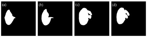 An Automatic Segmentation Method of Liver Tumor Region Images in Abdominal CT Sequence Images