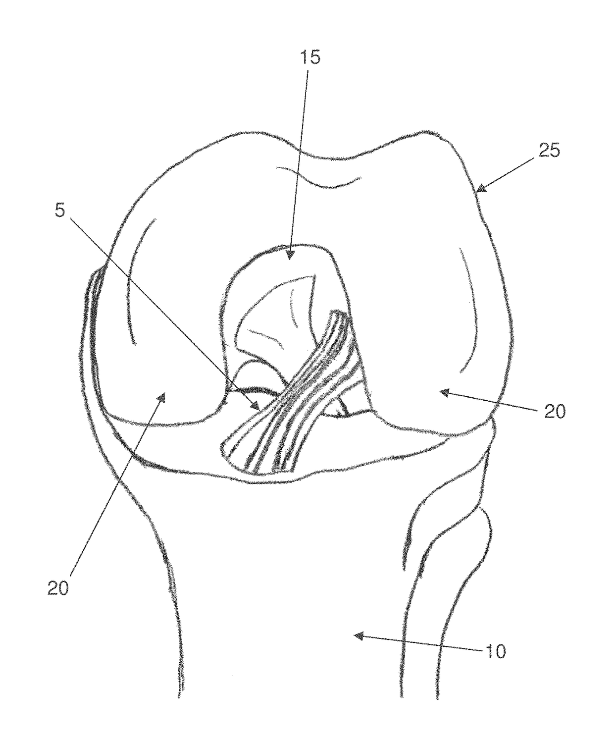 Apparatus and method for anatomic ACL reconstruction