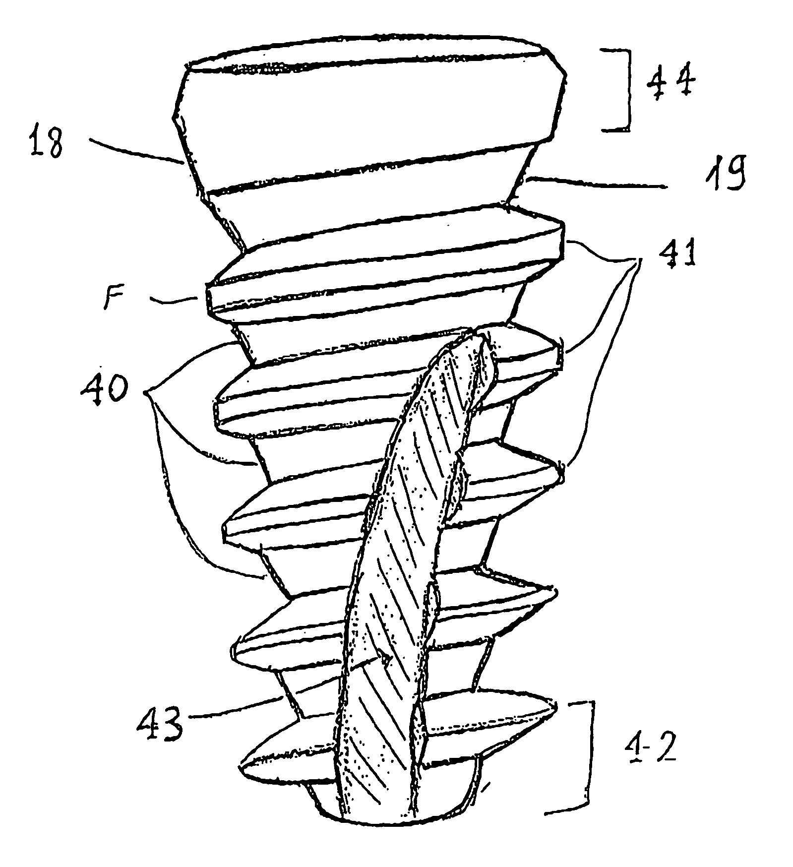 Condensing skeletal implant that facilitate insertions