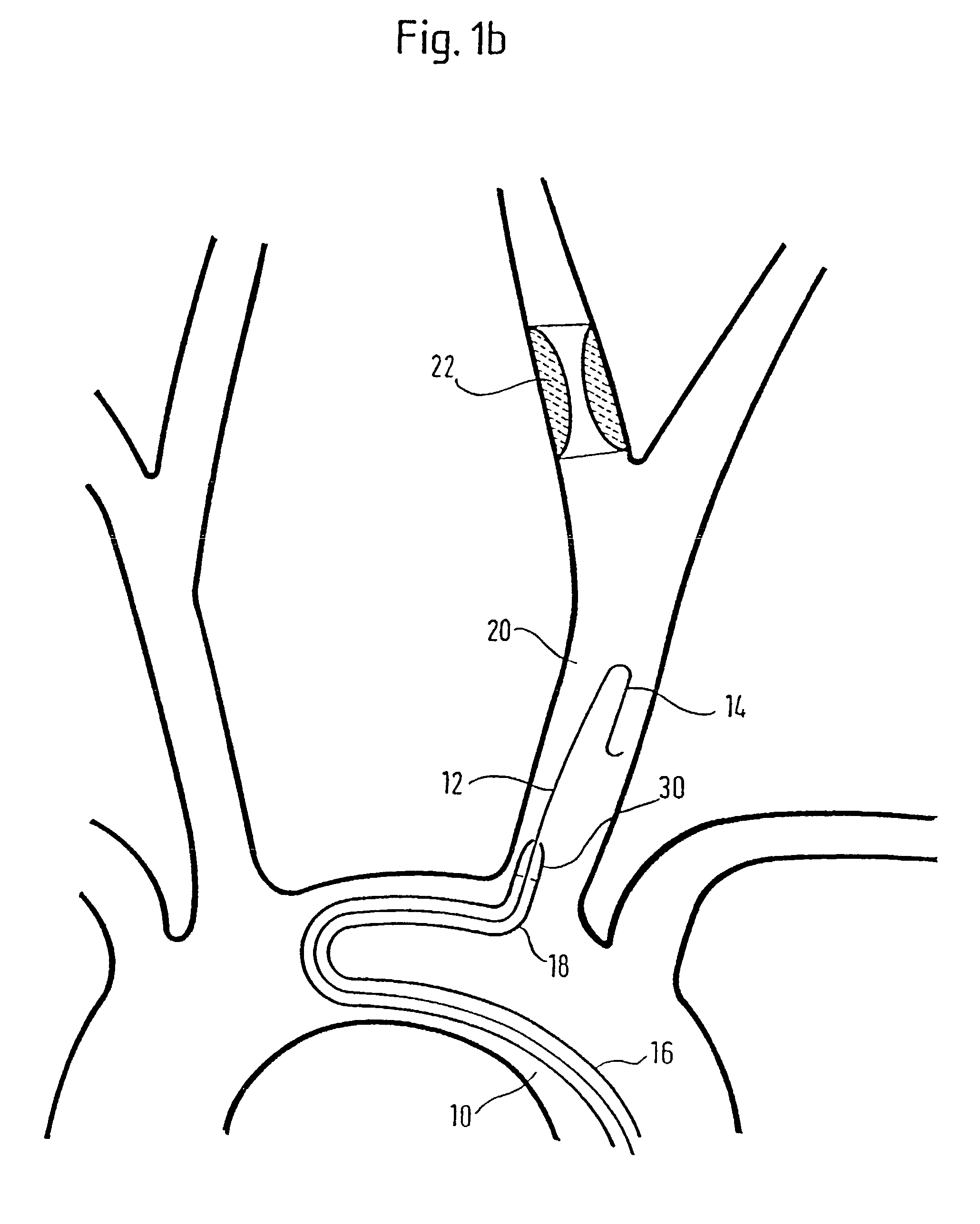 Implant delivery device
