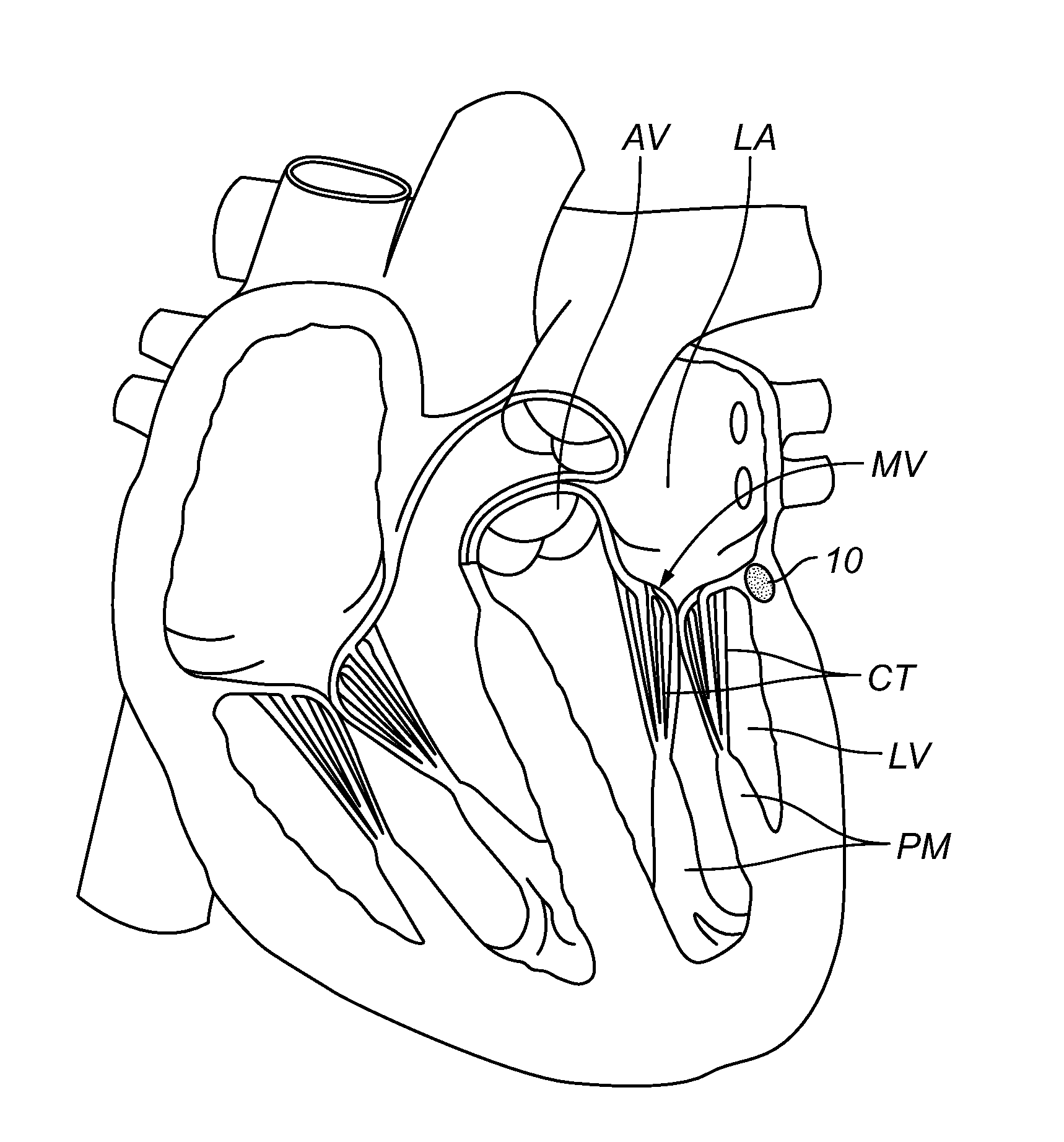 Repair of Incompetent Heart Valves by Interstitial Implantation of Space Occupying Materials or Devices