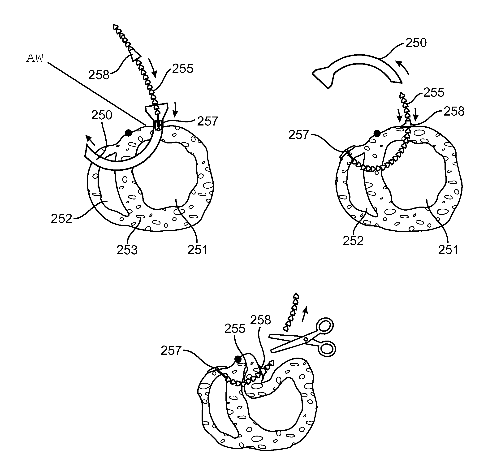 Method and device for treating dysfunctional cardiac tissue