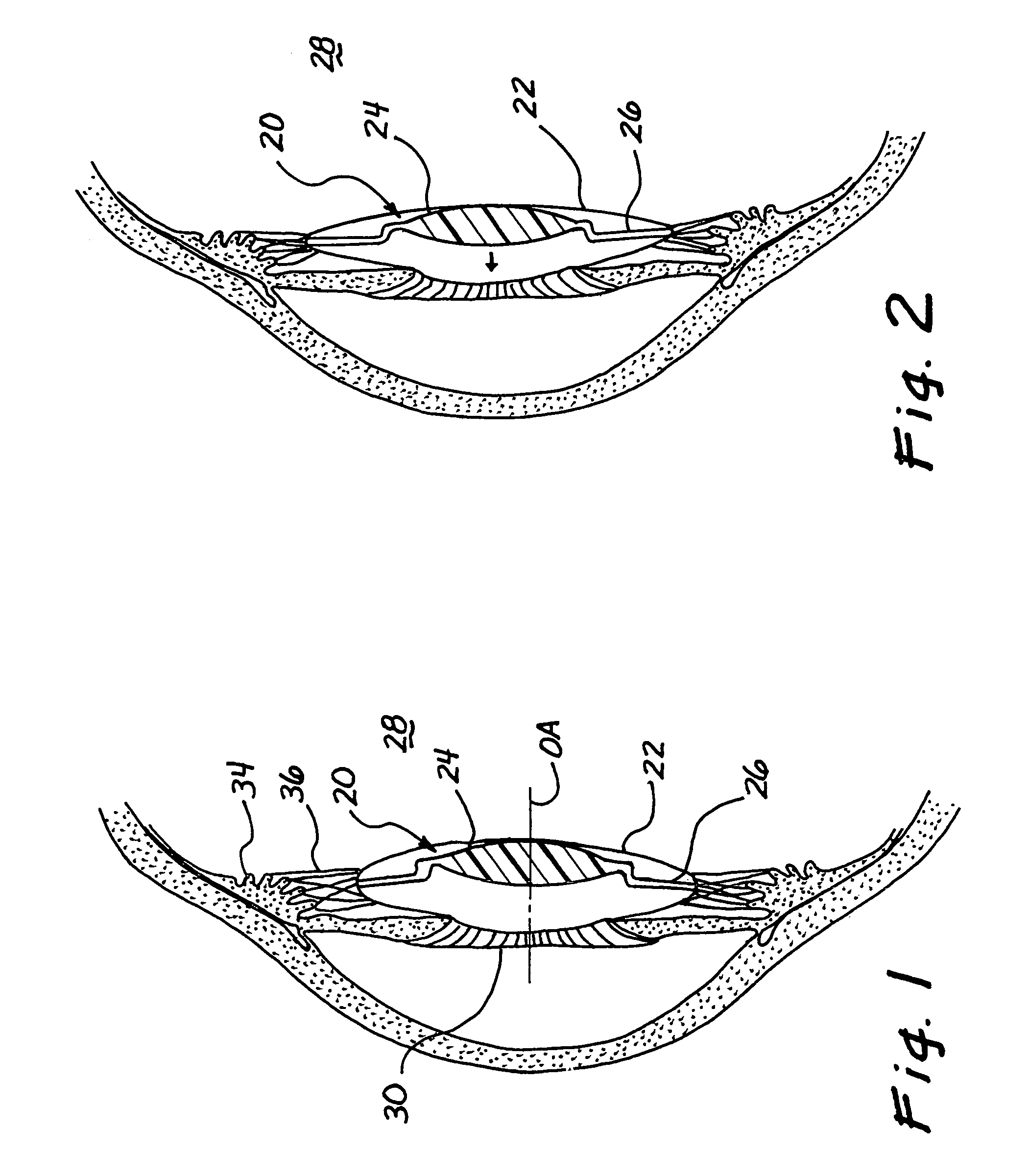 Accommodating intraocular lens with elongated suspension structure