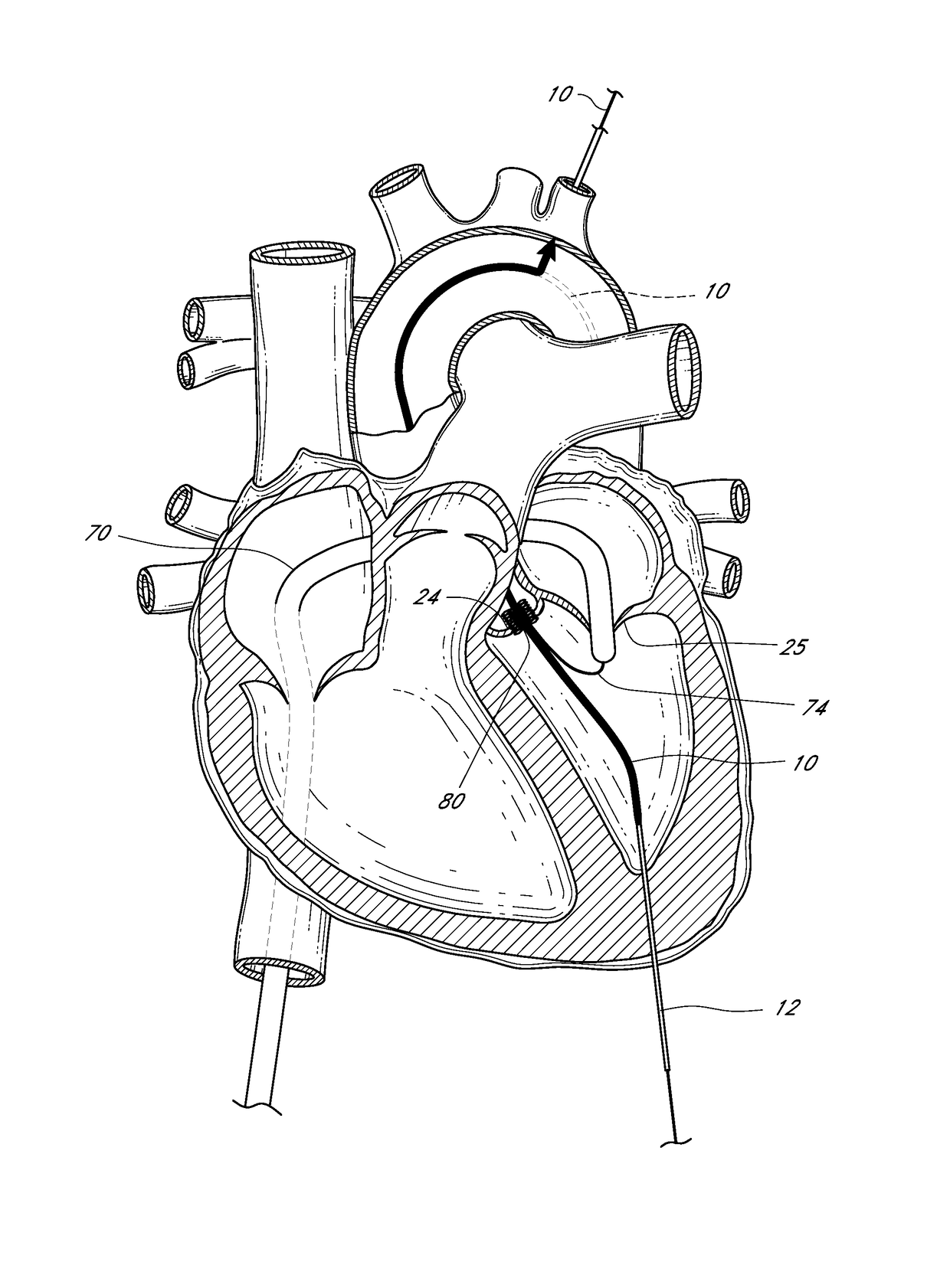 Cardiovascular access and device delivery system