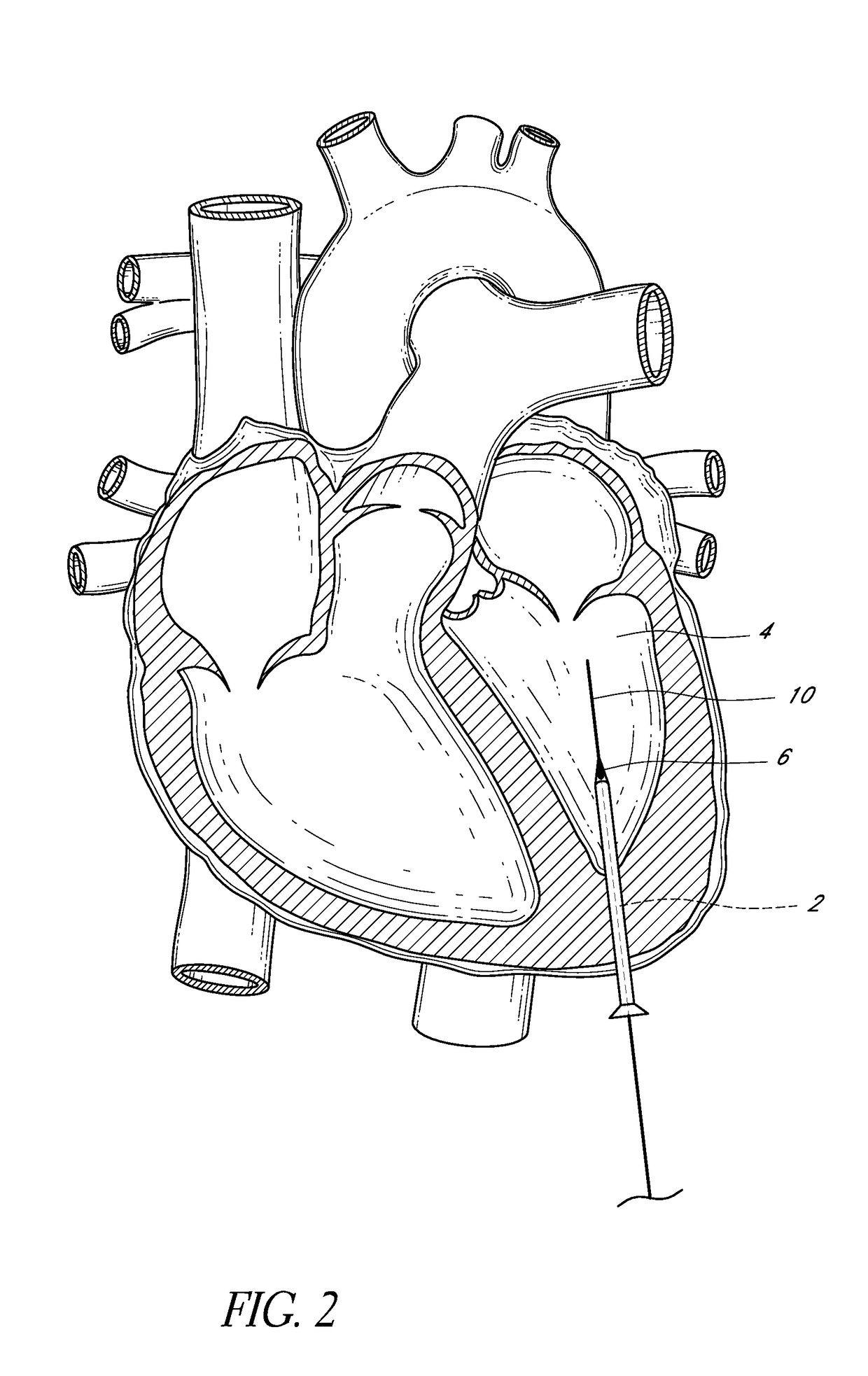 Cardiovascular access and device delivery system