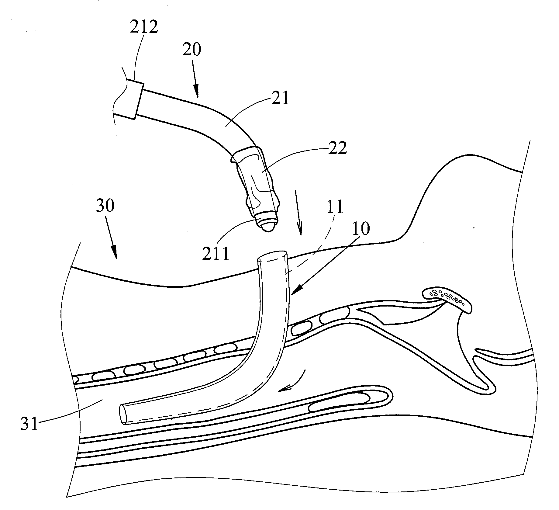 Device for Positioning Tracheostomy Tube