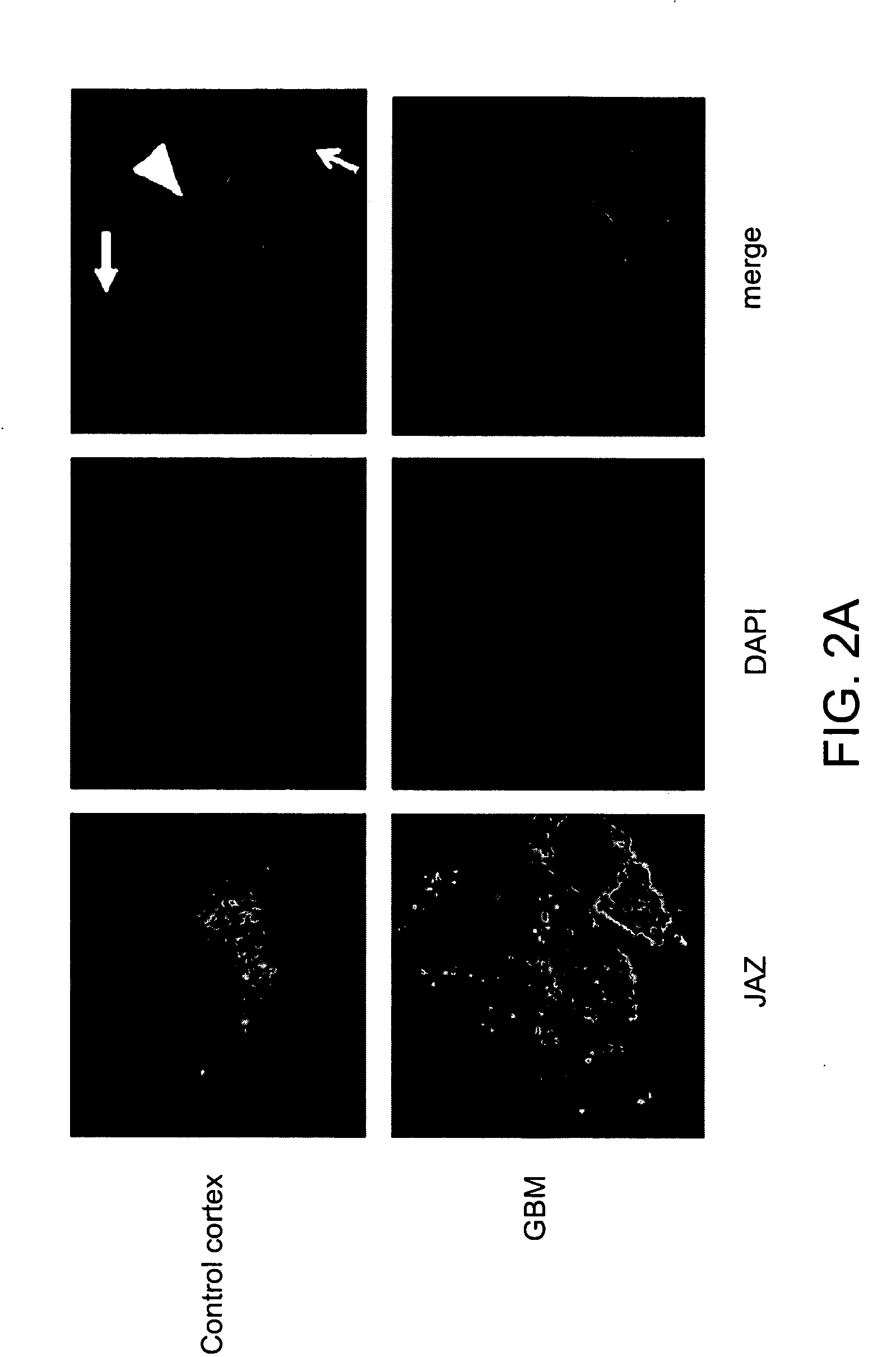 Compositions and methods for the treatment of neoplasia