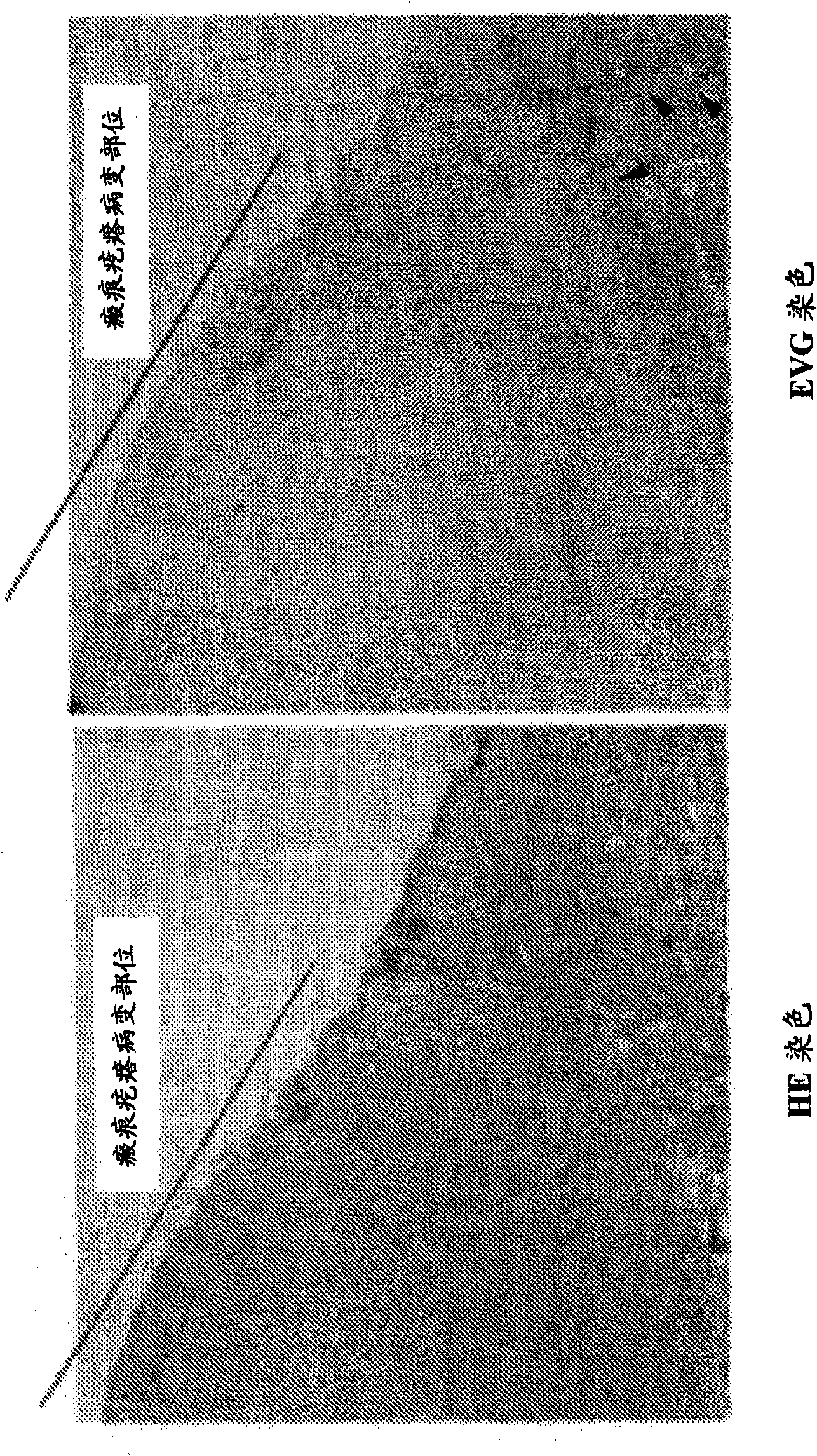 Radical therapeutic agent for keloid and hypertrophic scar