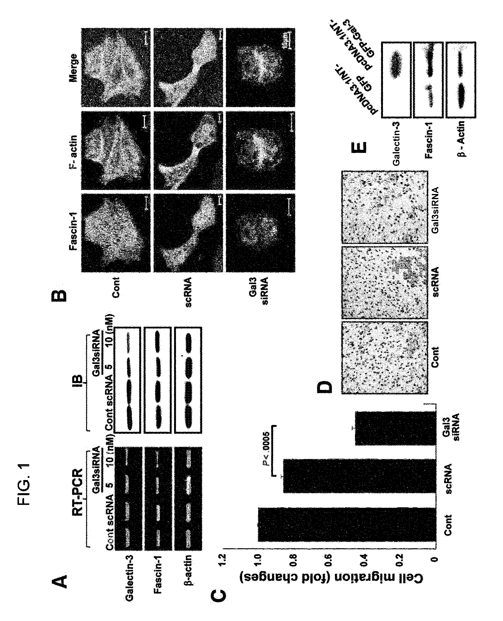 Method for screening cancer therapeutic agent using galectin-3, GSK-3β, and fascin-1