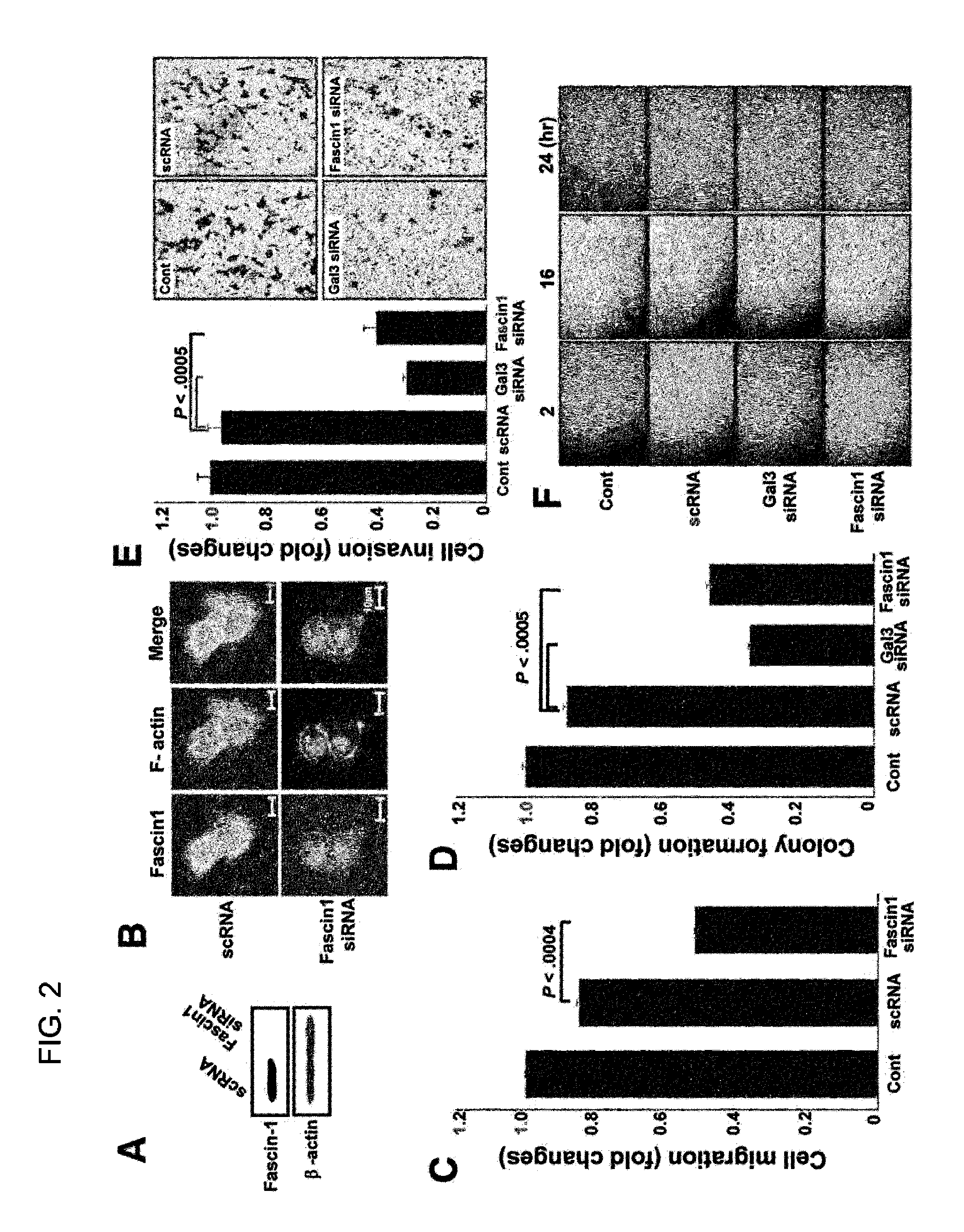 Method for screening cancer therapeutic agent using galectin-3, GSK-3β, and fascin-1
