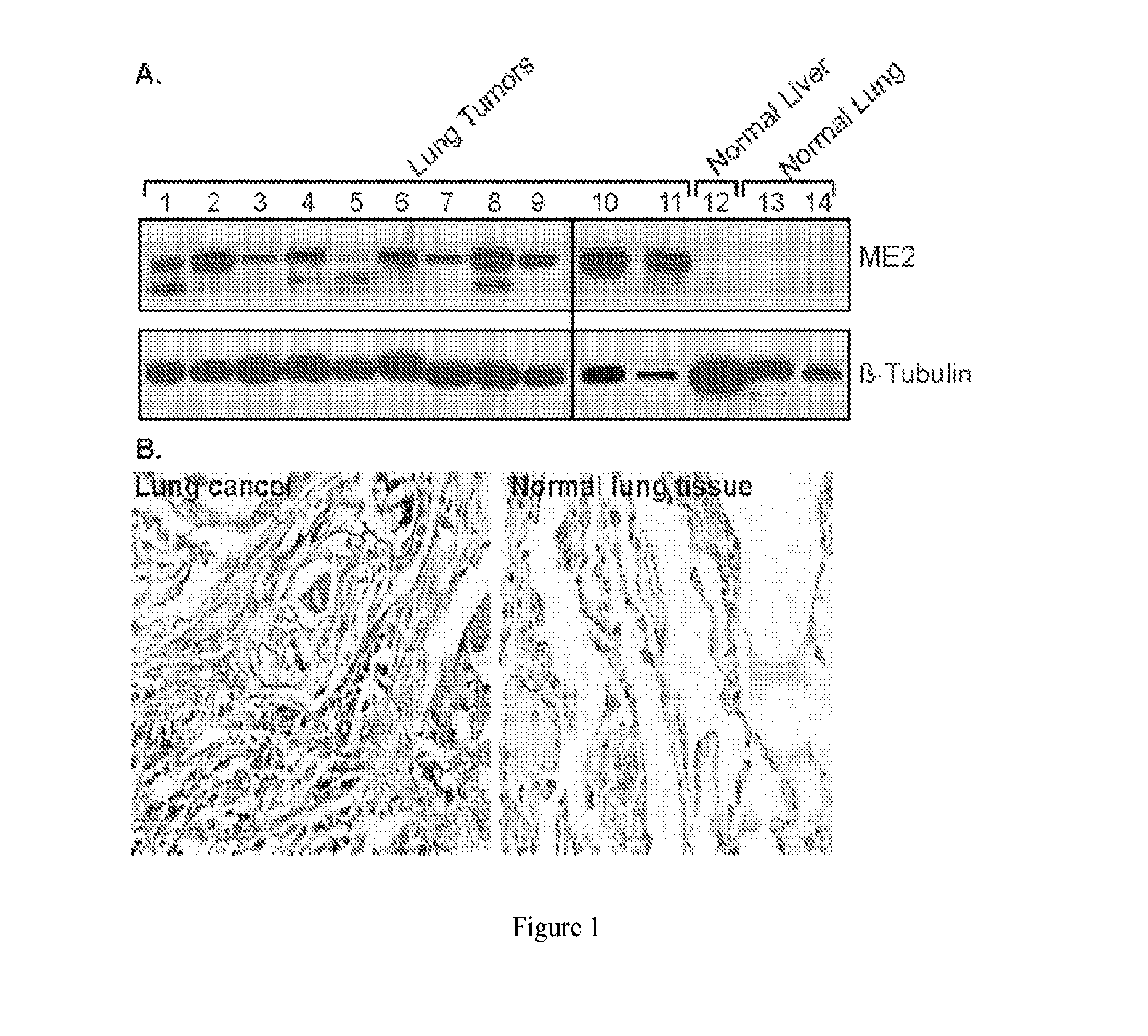 Methods of treating proliferative disorders with malate or derivatives thereof
