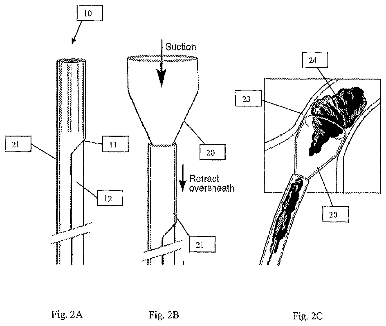 Systems and methods for removing undesirable material within a circulatory system utilizing a balloon catheter