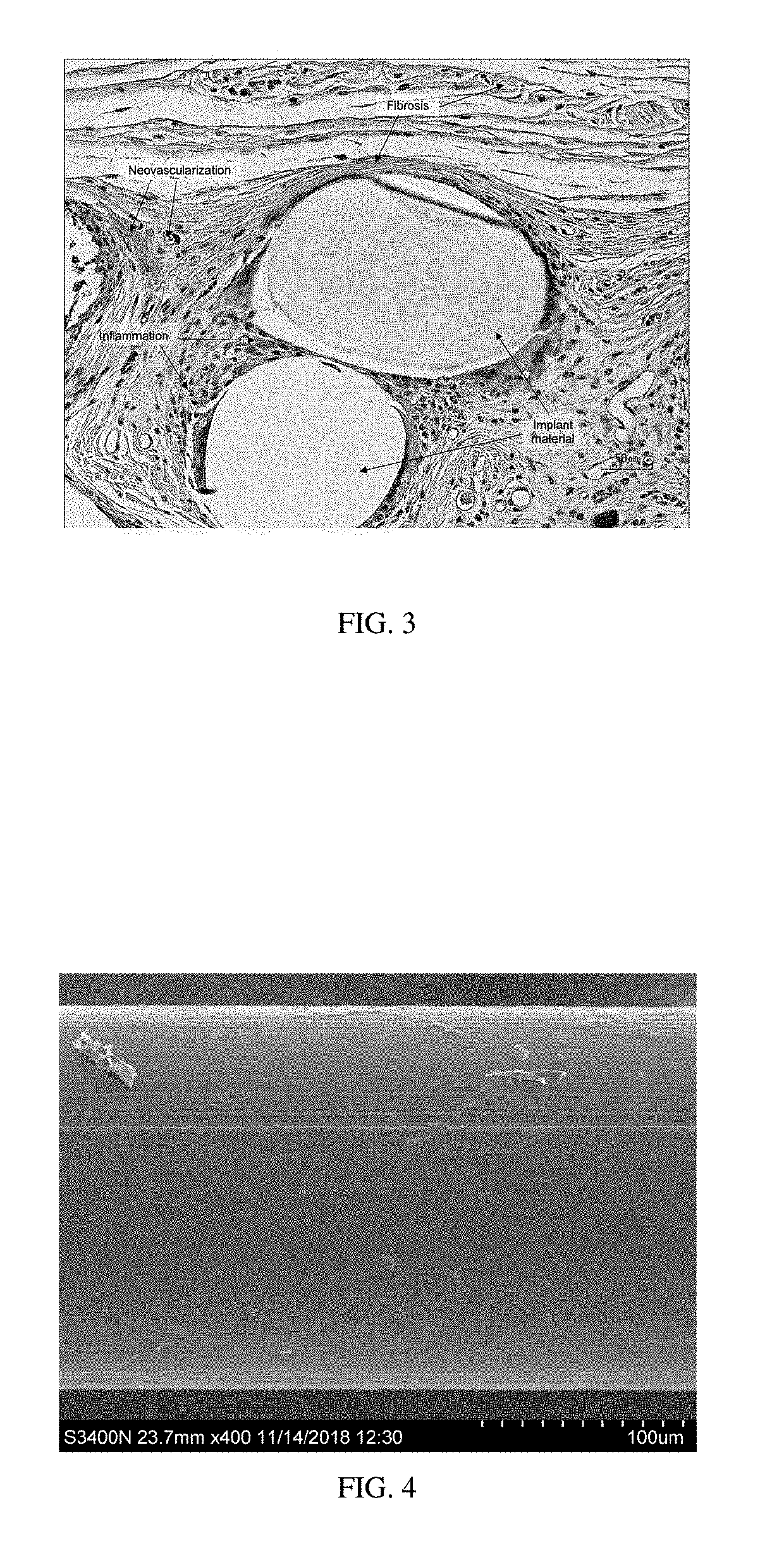 Surgial mesh implants containing poly(butylene succinate) and copolymers thereof