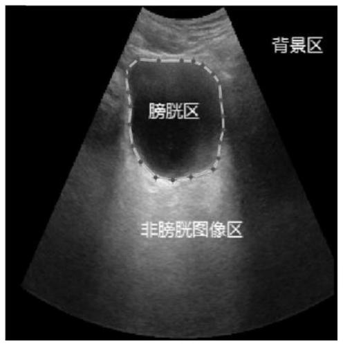 Medical ultrasonic image segmentation method and device