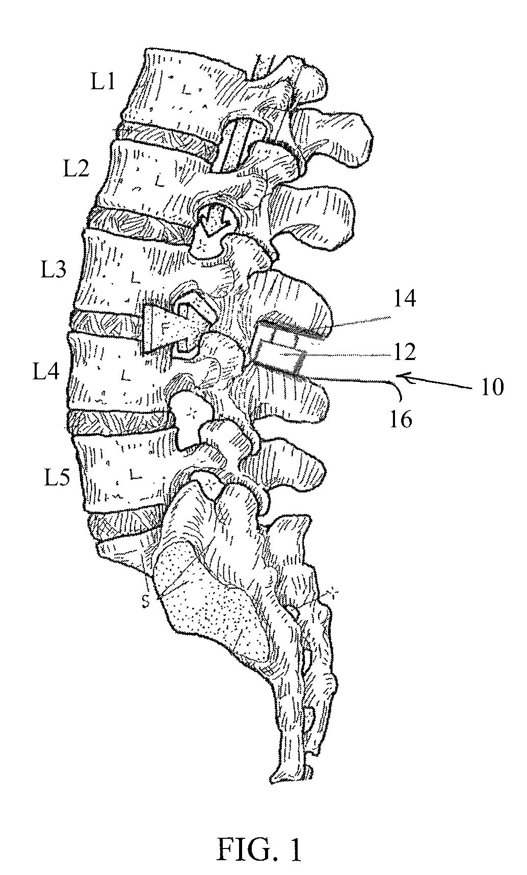 Spinal implant having a post-operative adjustable dimension