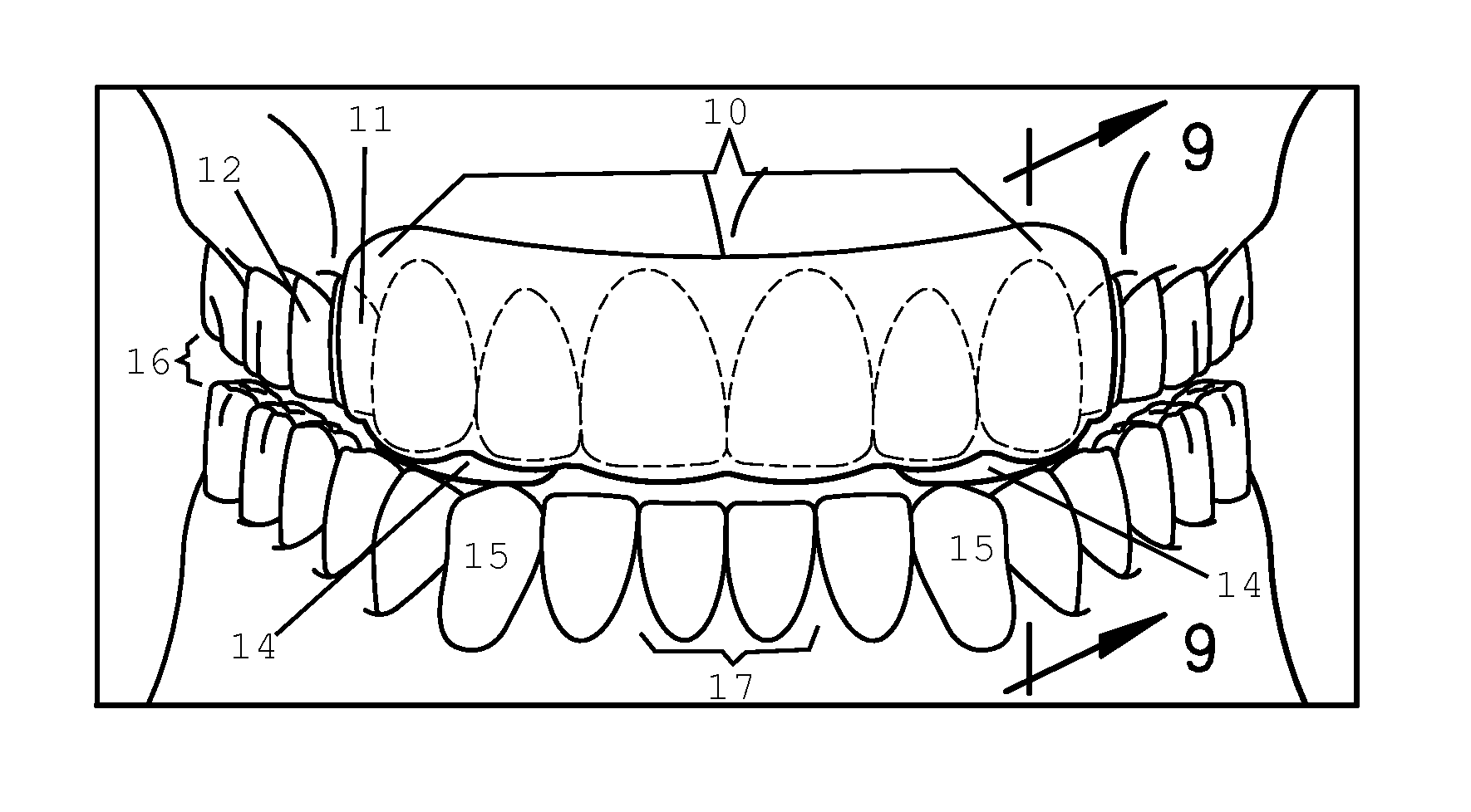 Intraoral Discluding Appliance