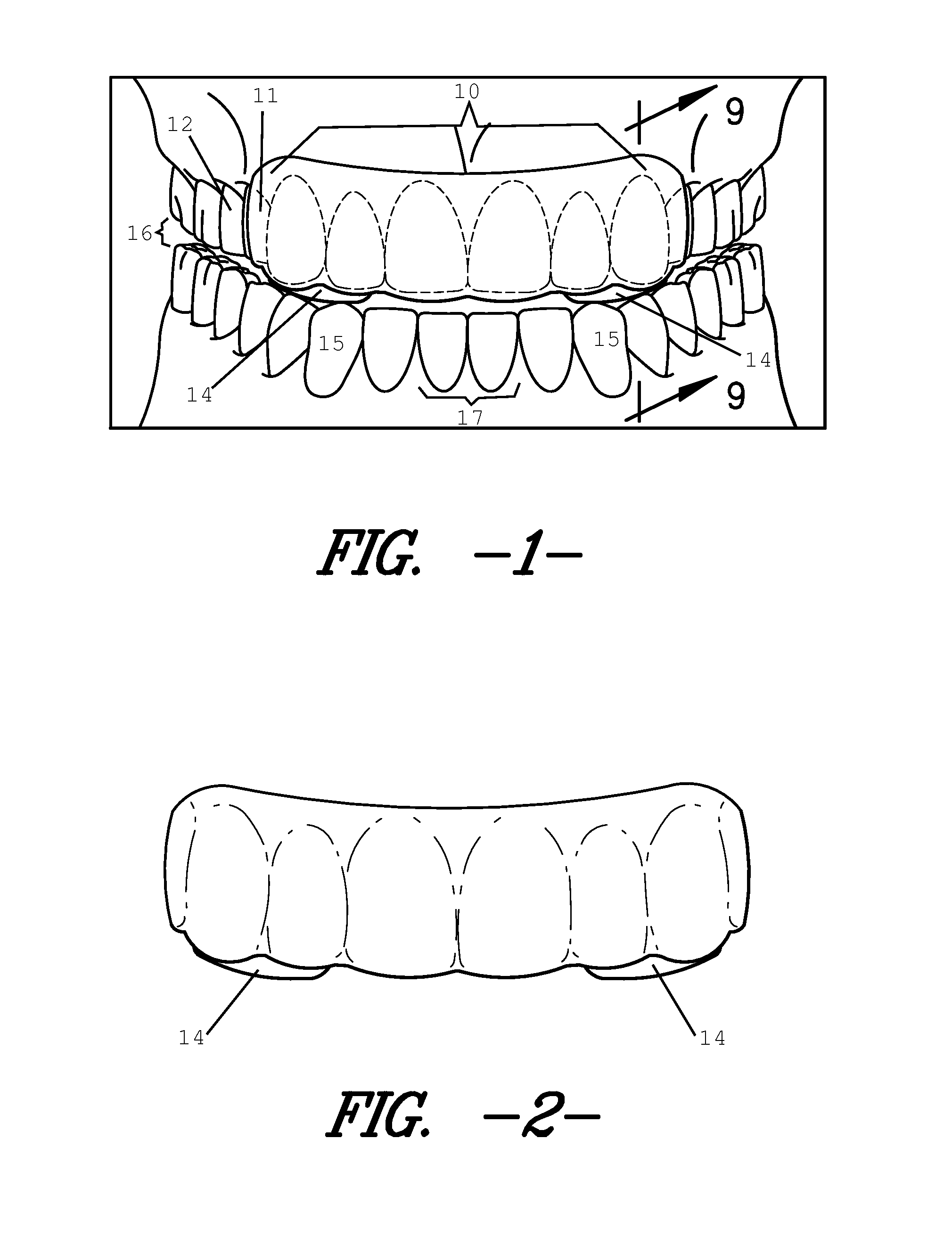 Intraoral Discluding Appliance