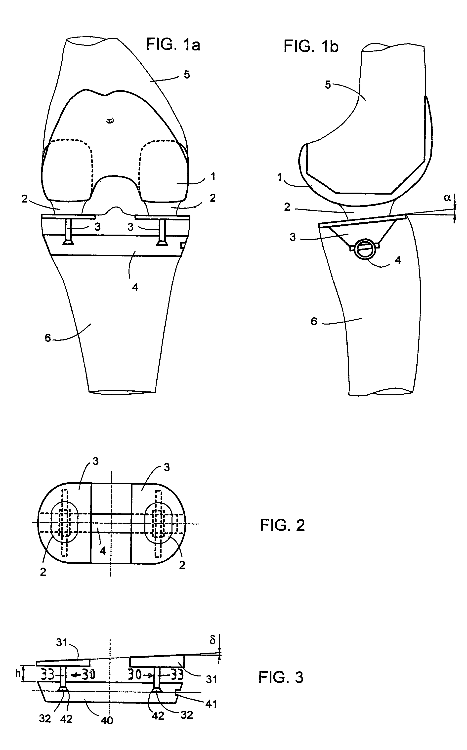 Knee joint endoprosthesis system
