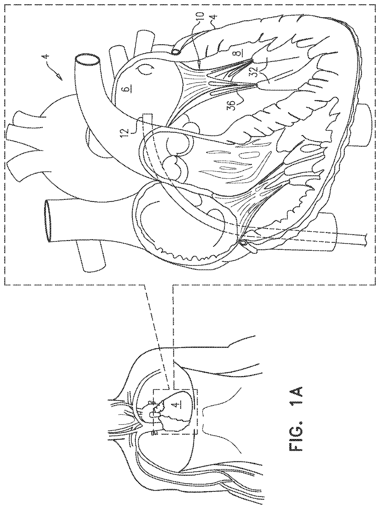 Cinching of dilated heart muscle