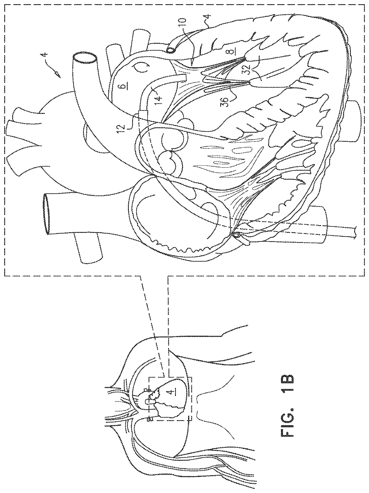 Cinching of dilated heart muscle