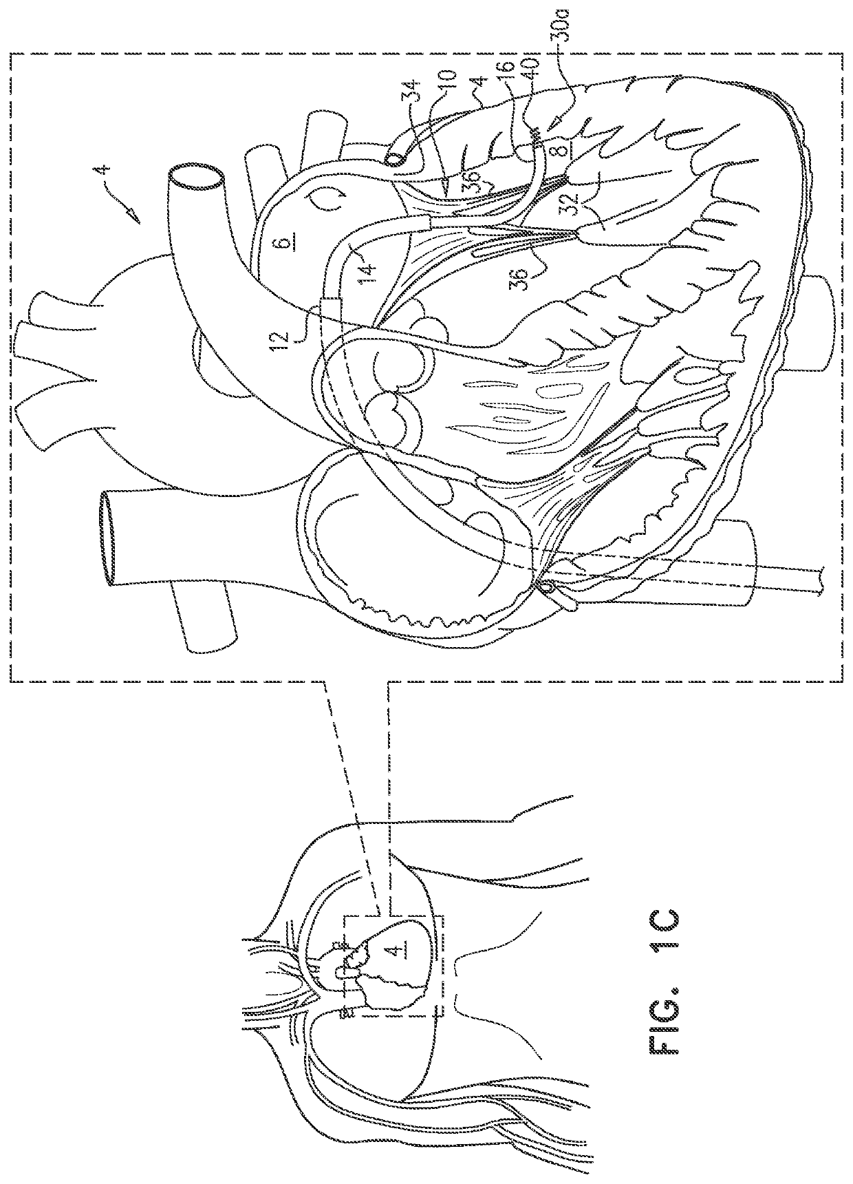 Cinching of dilated heart muscle