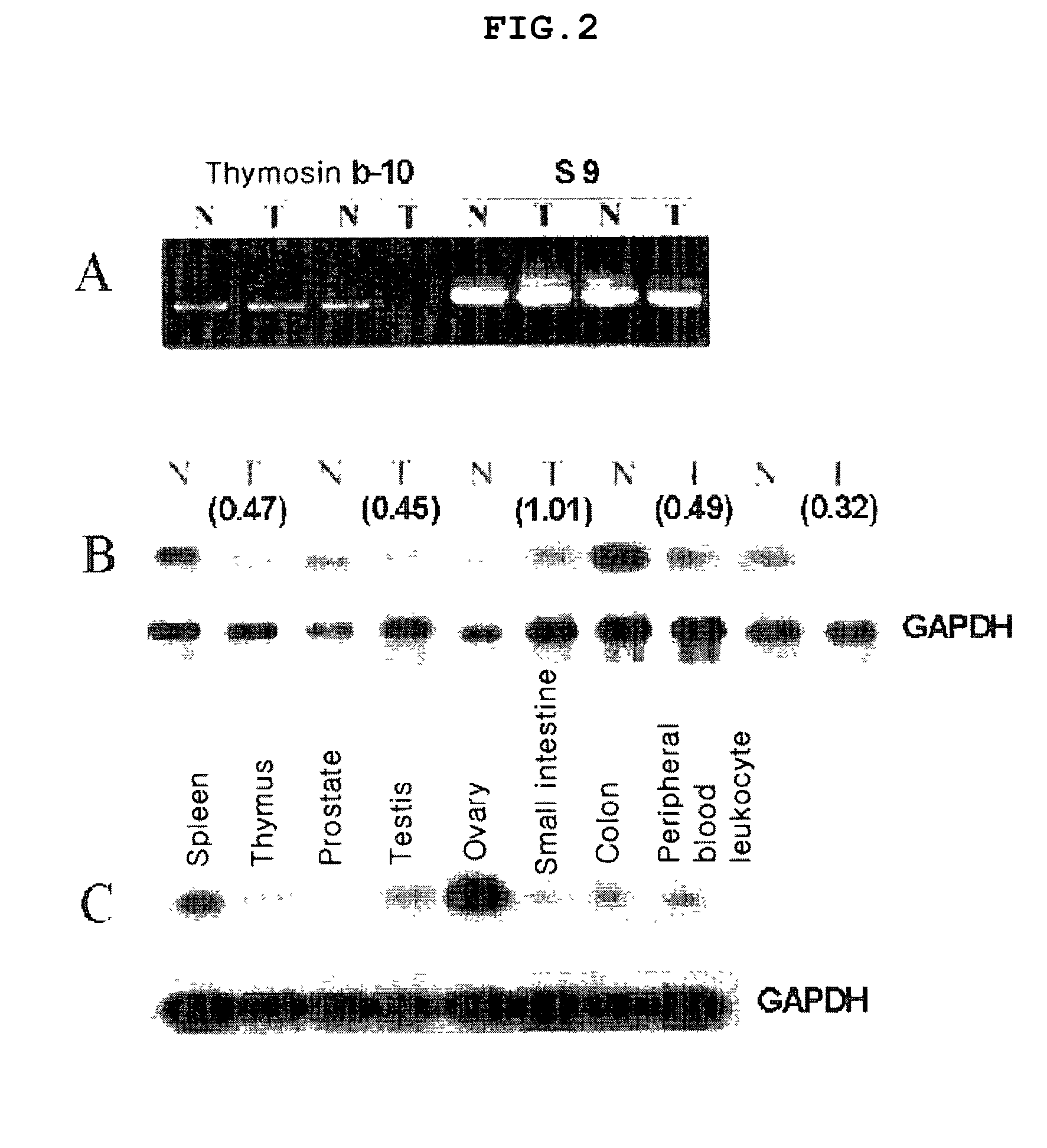 Method for using thymosin β-10 for gene therapy of solid malignant tumors